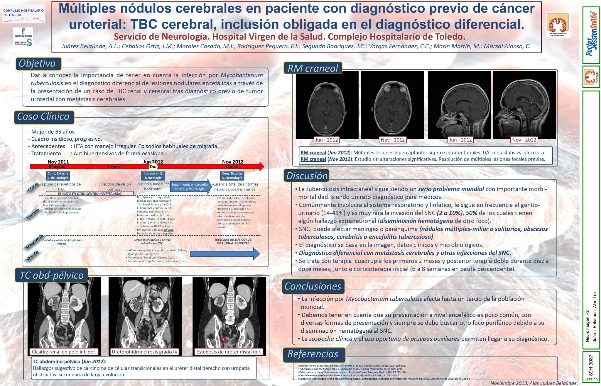 Múltiples nódulos cerebrales en paciente con diagnóstico previo de cáncer uroterial: TBC cerebral, inclusión obligada en el diagnóstico diferencial.