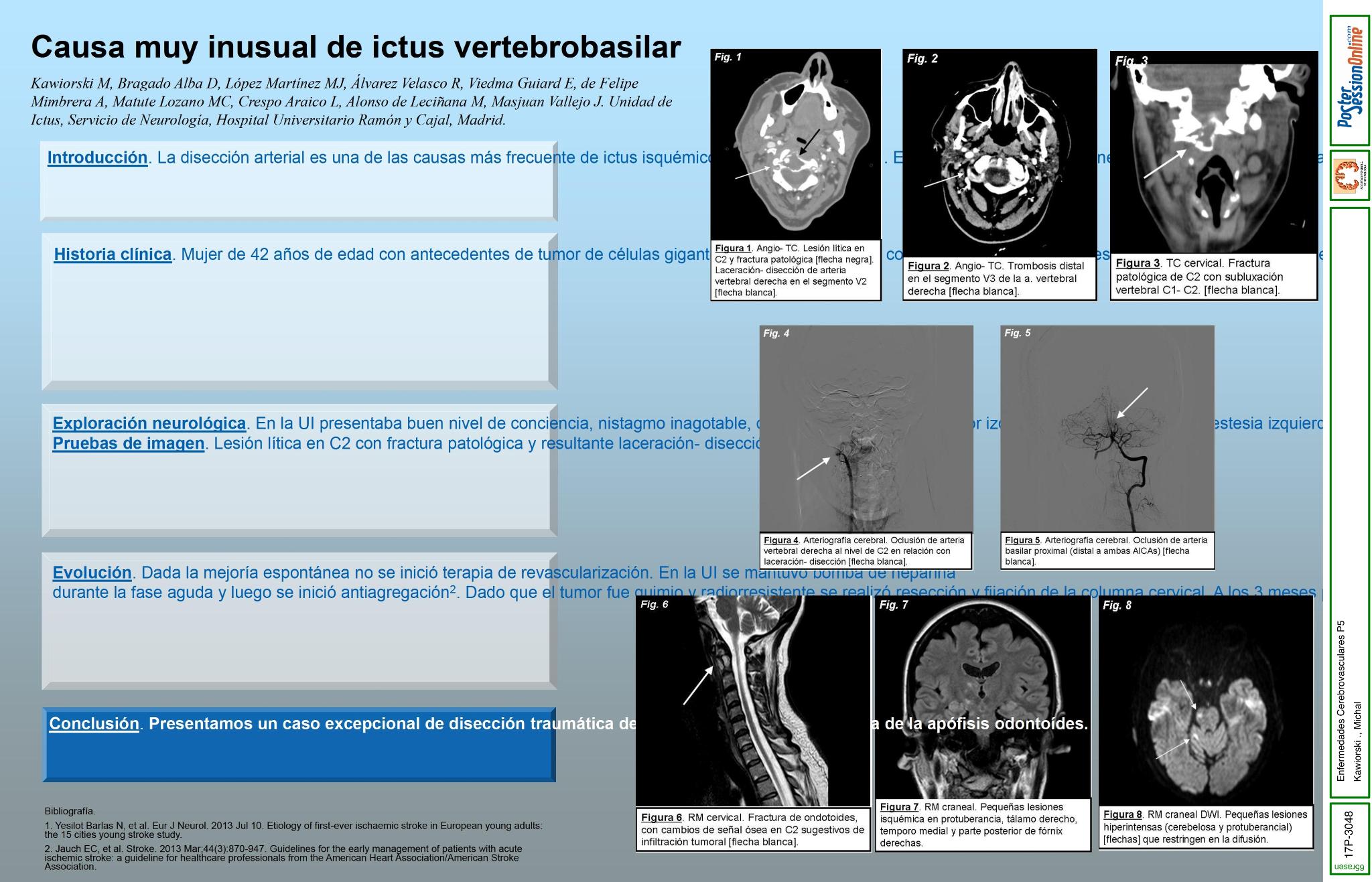 Causa muy inusual de ictus vertebrobasilar.