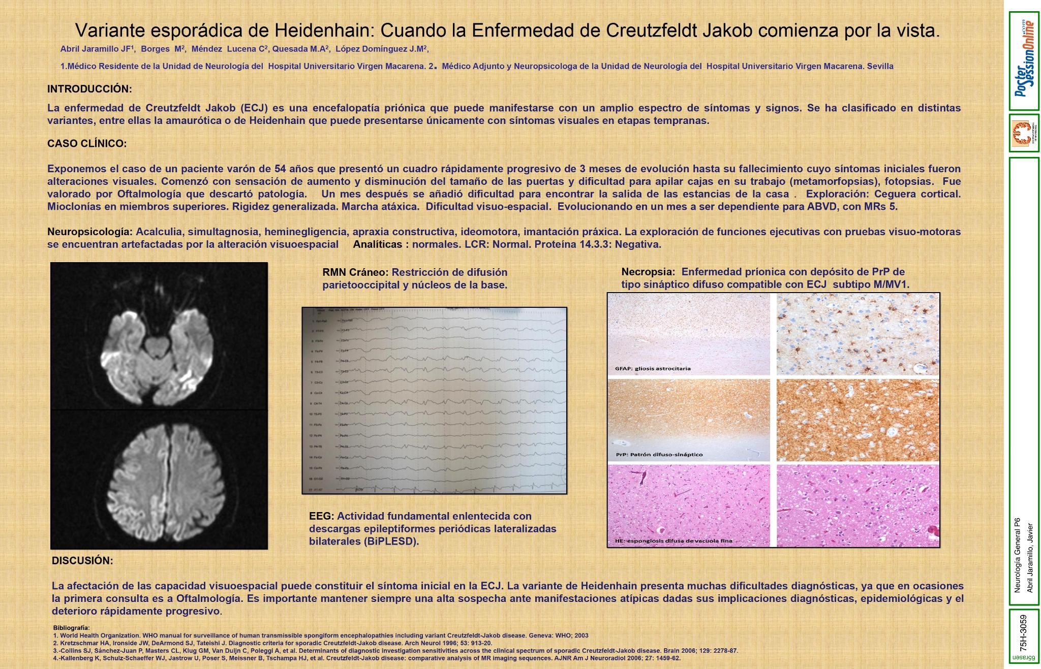 Variante esporádica de Heidenhain: Cuando la enfermedad de Creutzfeldt Jakob (ECJ) comienza por la vista.