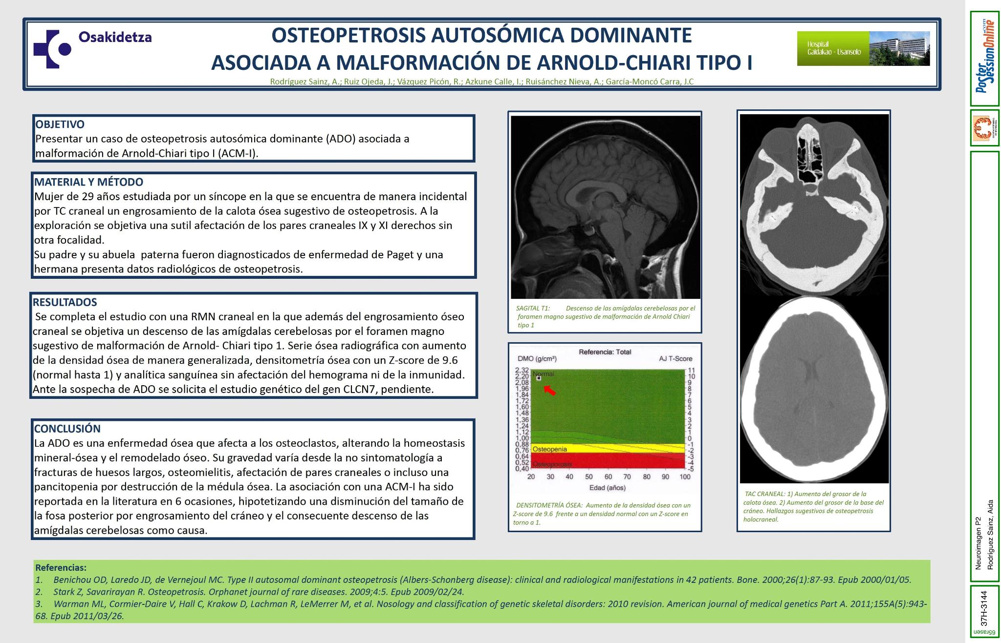 Osteopetrosis autosómica dominante asociada a malformación de Arnold-Chiari tipo I