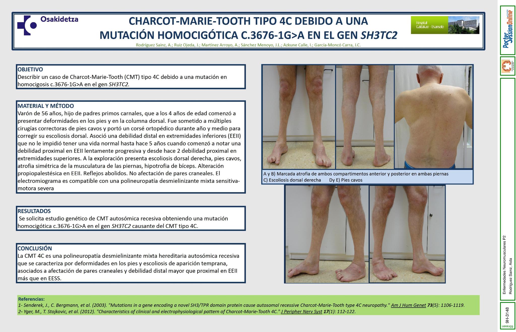 Charcot-Marie-Tooth tipo 4C debido a una mutación homocigótica c.3676-1G>A en el gen SH3TC2