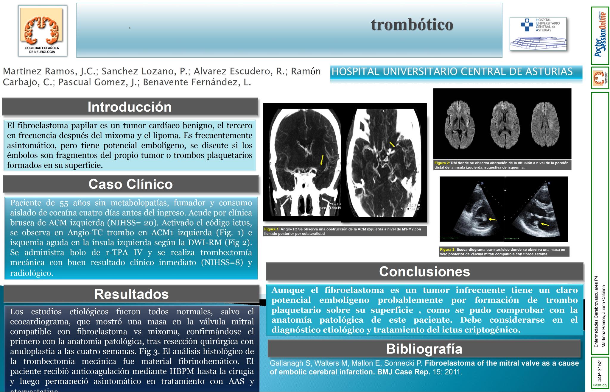 Fibroelastoma con embolismo trombótico como causa de ictus trombectomizado