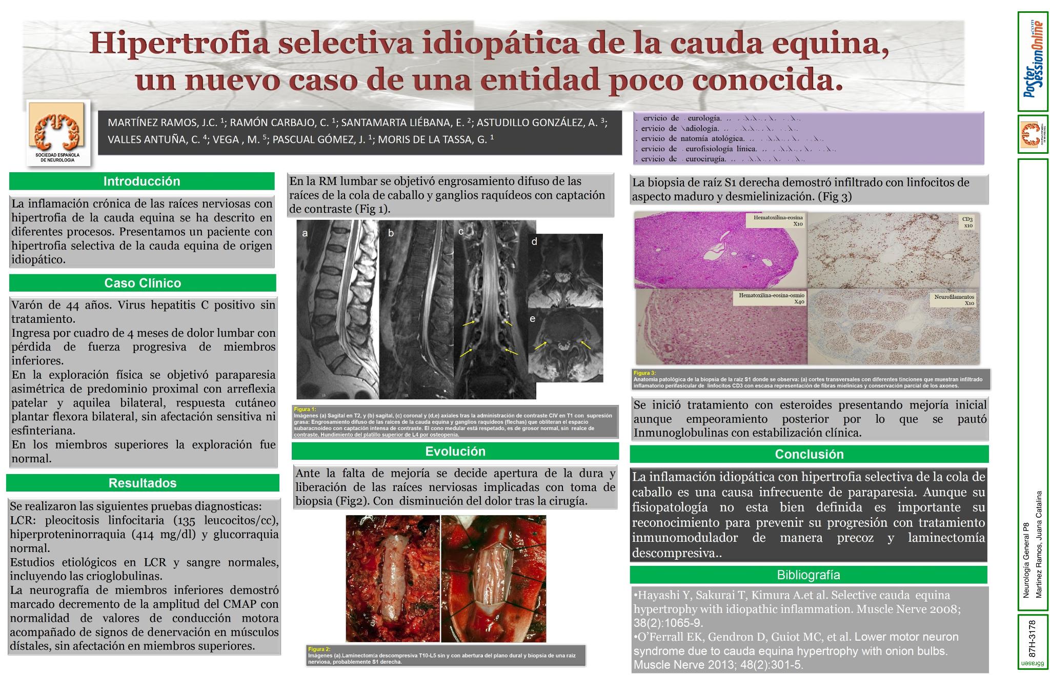 Hipertrofia selectiva idiopática de la cauda equina, un nuevo caso de una entidad poco conocida.
