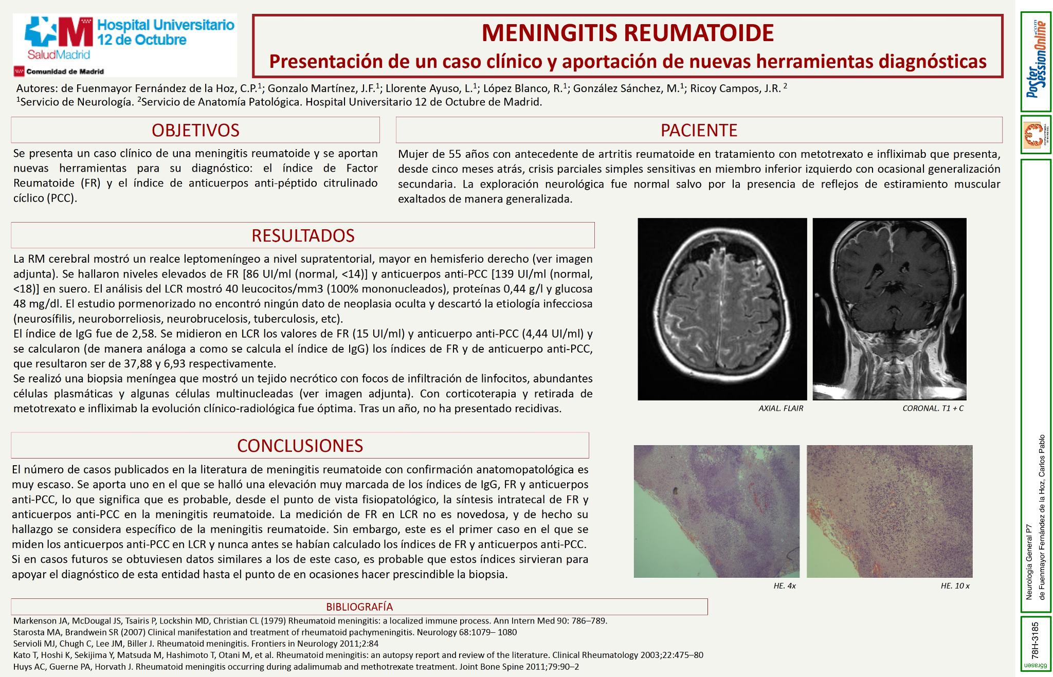 Leptomeningitis crónica de etiología excepcional: meningitis reumatoide.