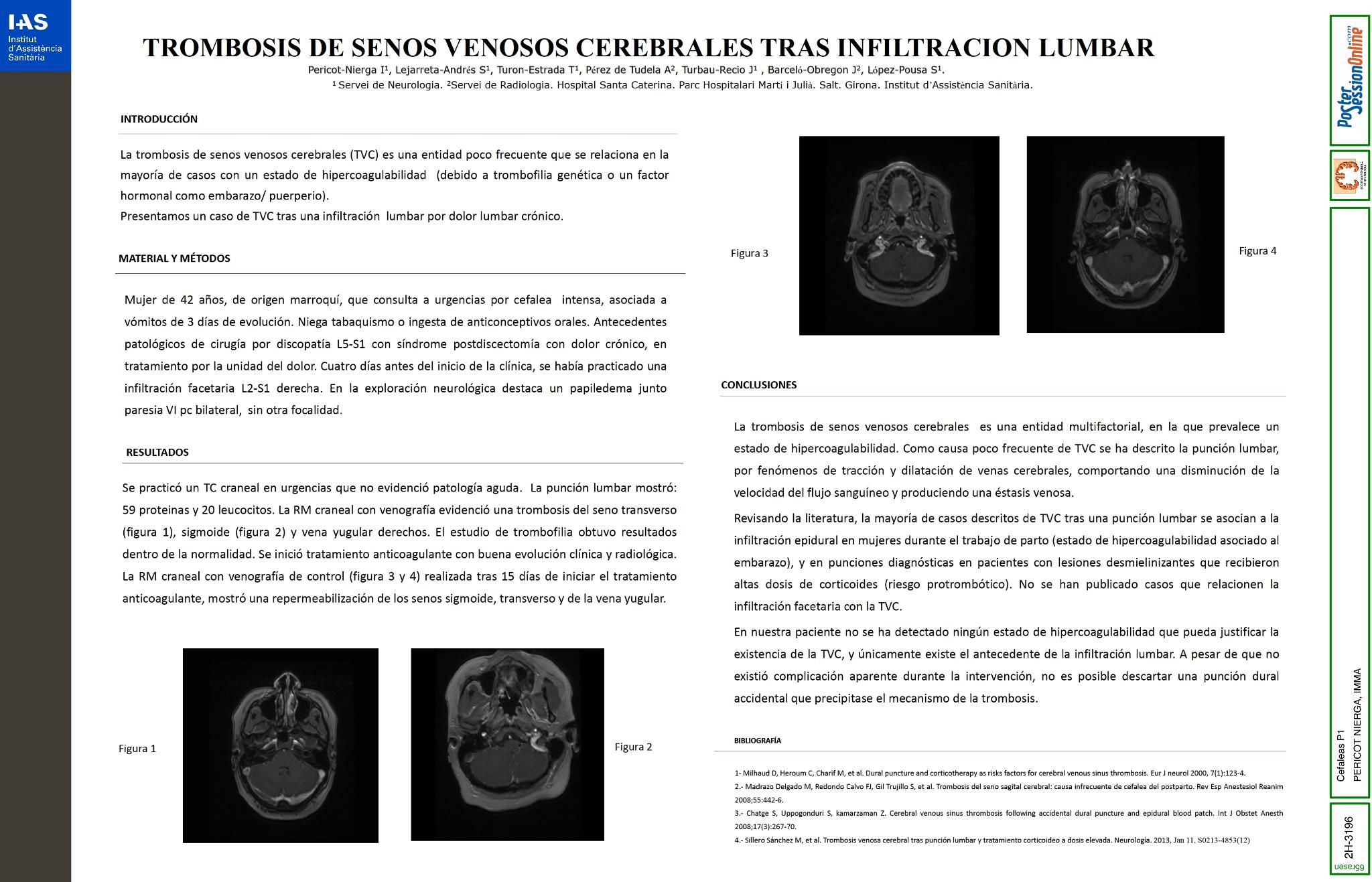 Trombosis de senos venosos cerebrales tras infiltracion lumbar