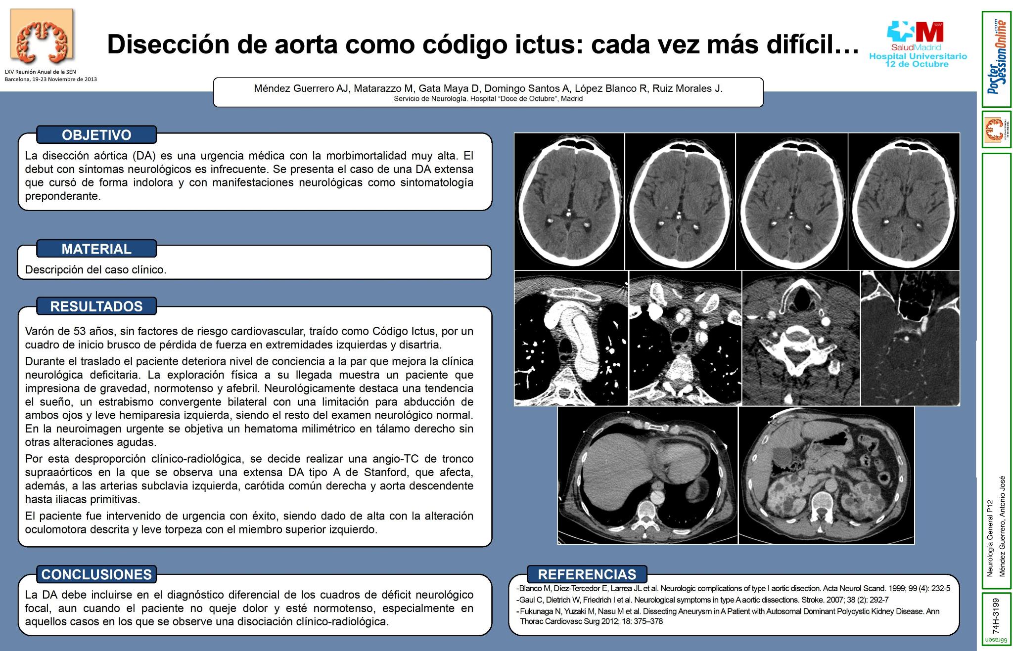 Disección de aorta como código ictus, cada vez más difícil...