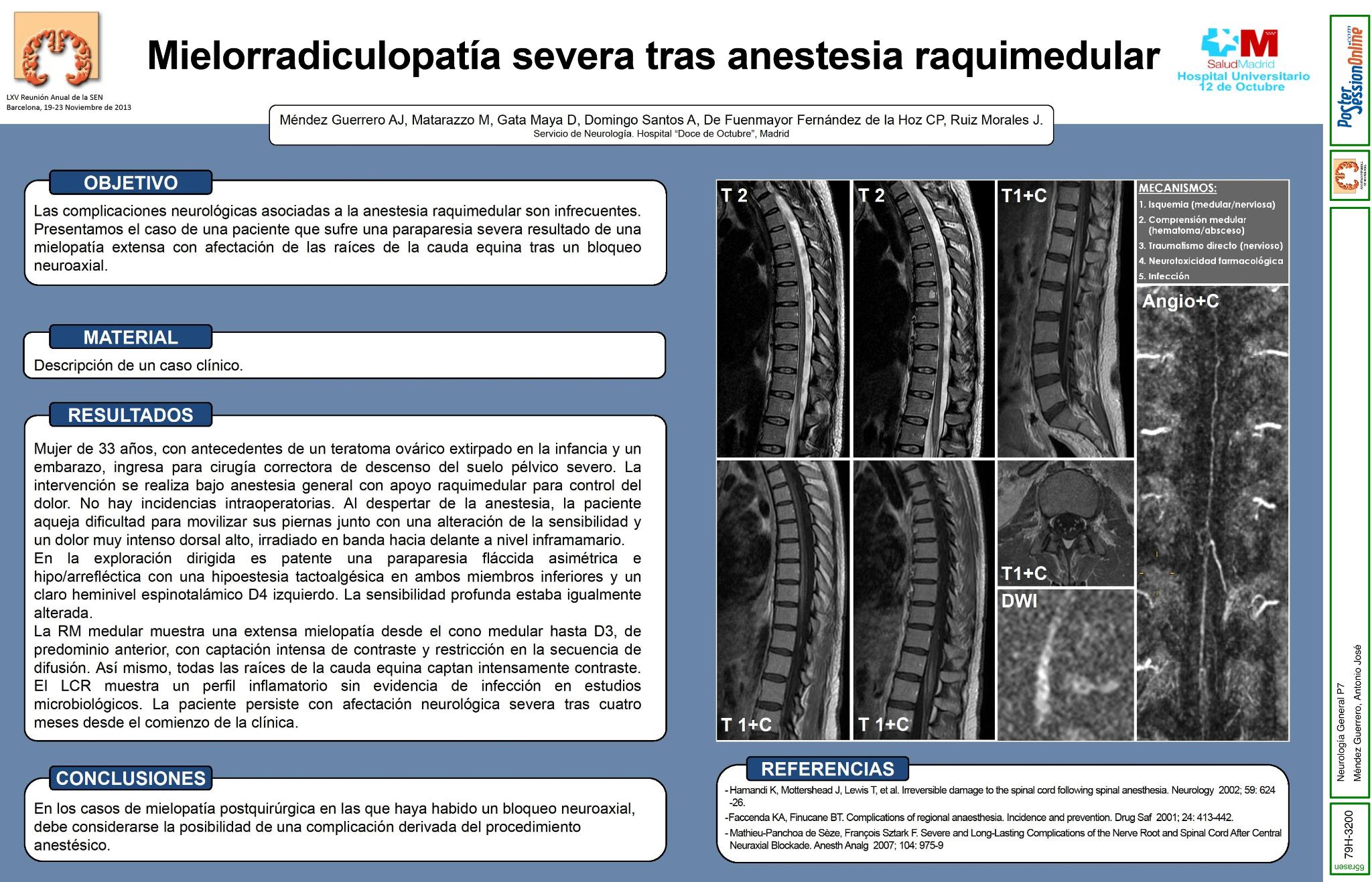 Mielorradiculopatía severa tras anestesia raquimedular