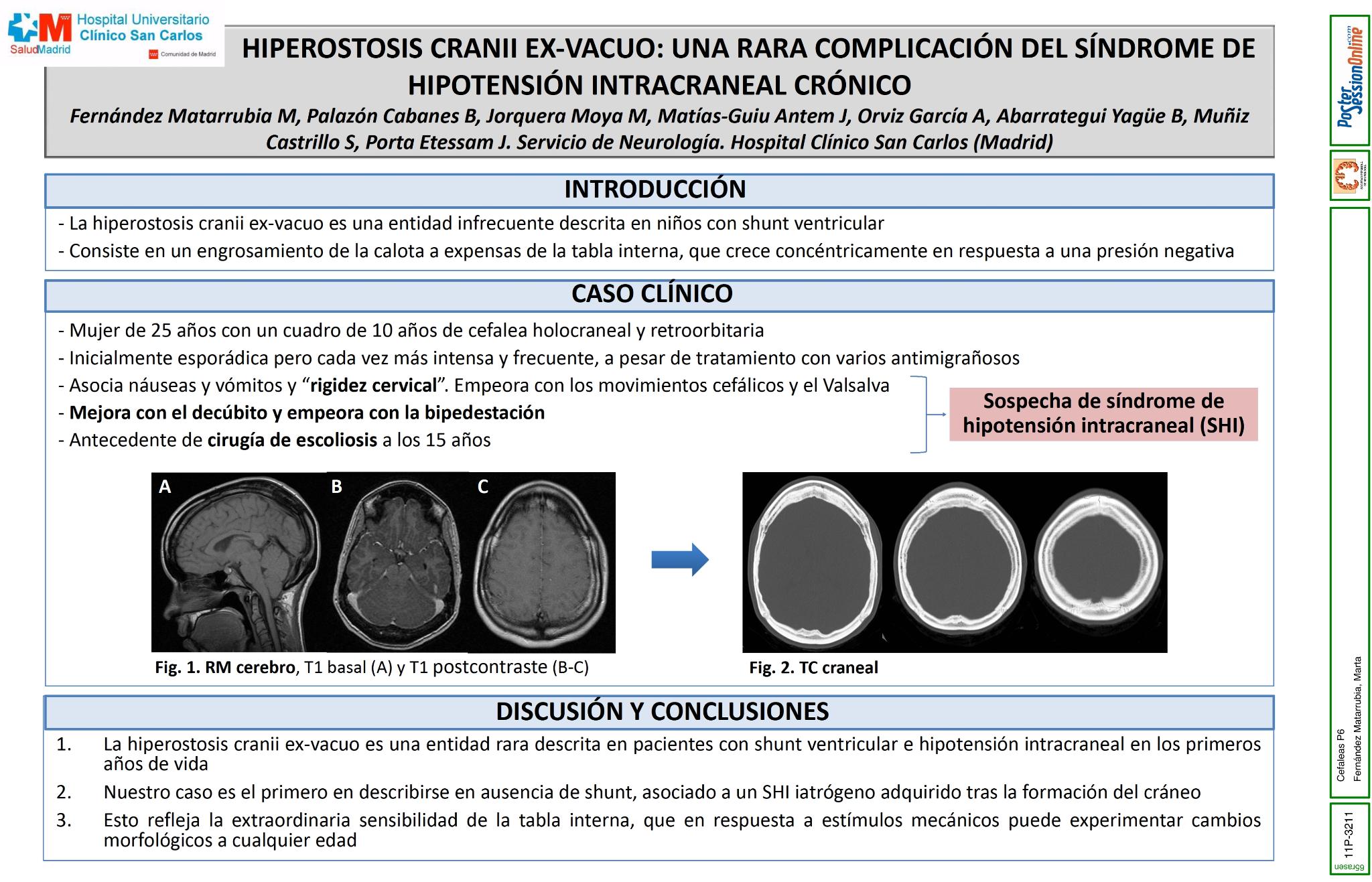 Hiperostosis cranii ex‐vacuo: una rara complicación de la hipotensión intracraneal crónica