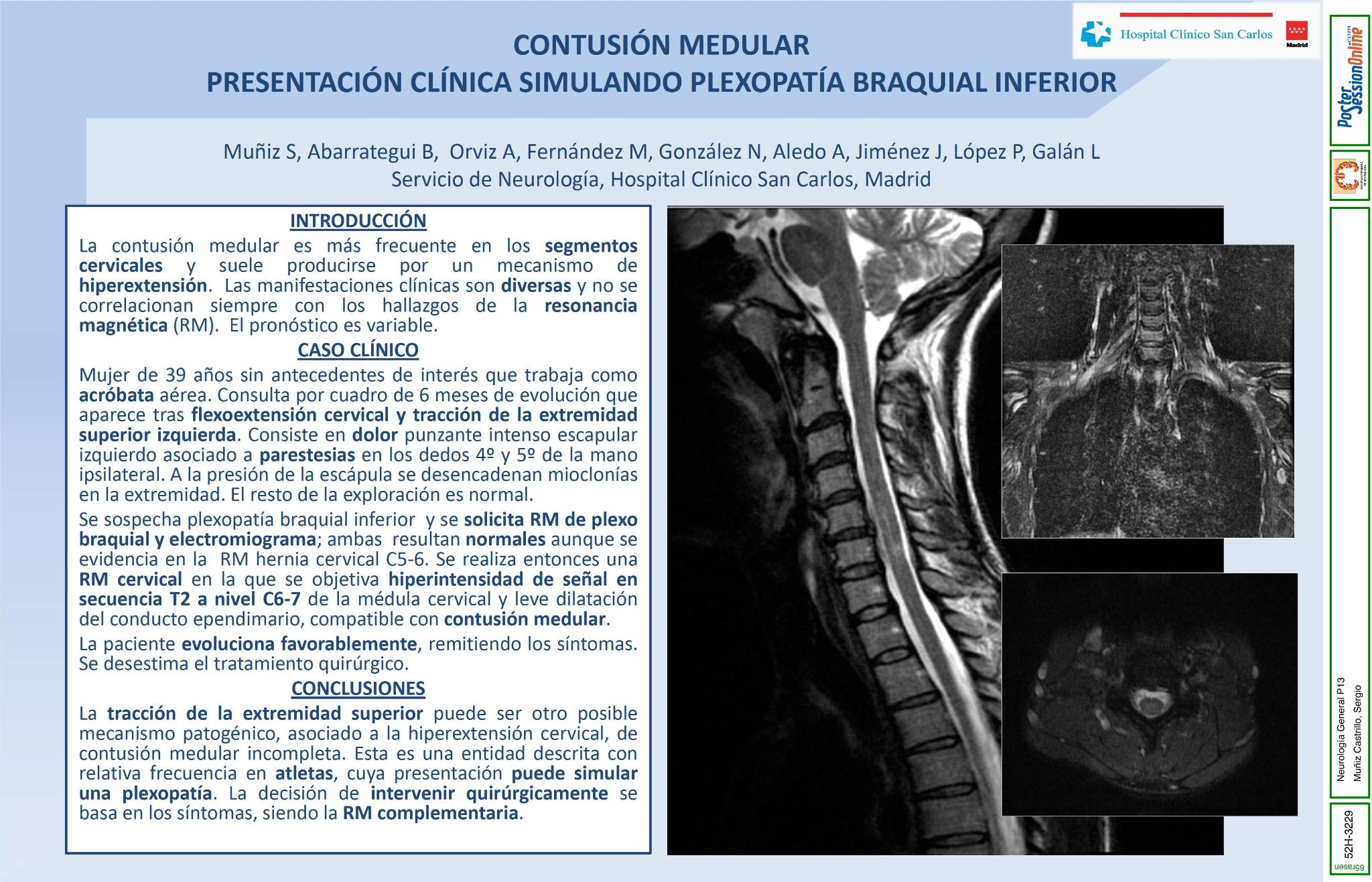Contusión medular: presentación clínica simulando plexopatía braquial inferior