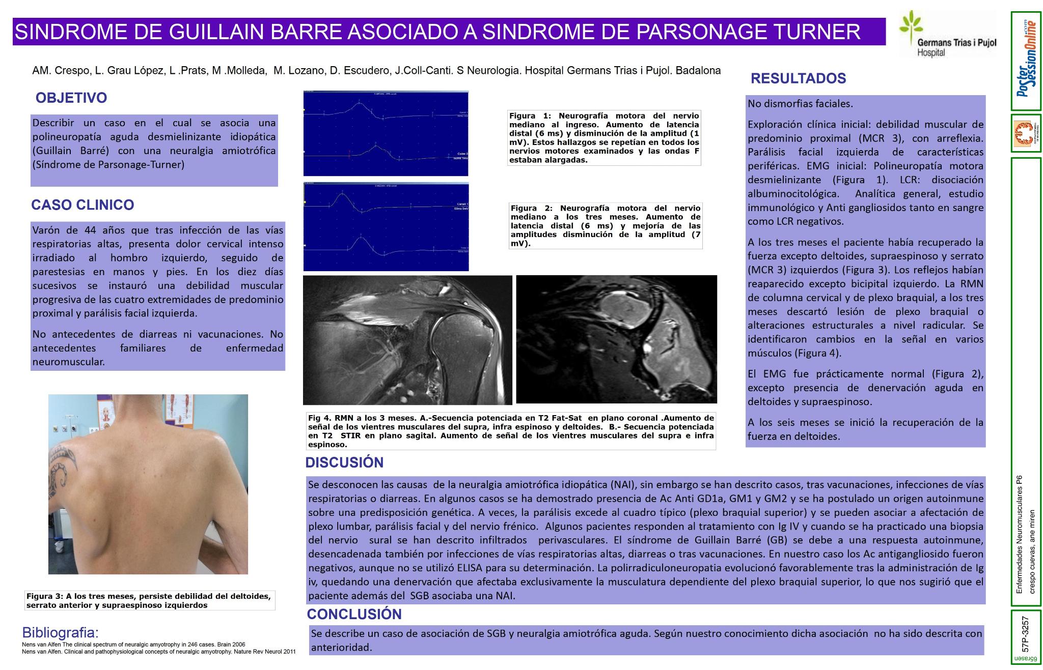 Sindrome de Guillain Barré asociado a síndrome de Parsonage Turner