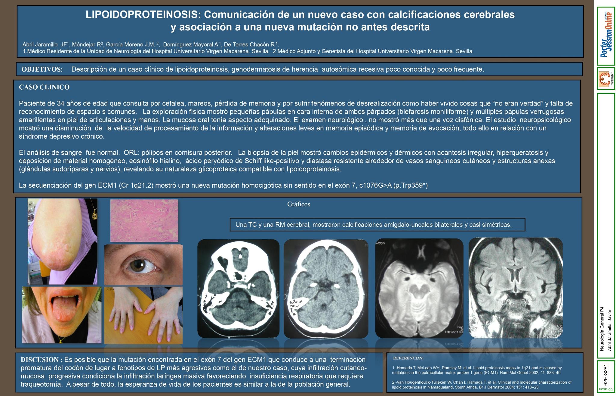 Lipoidoproteinosis: comunicación de un nuevo caso con calcificaciones cerebrales y asociación a una nueva mutación no antes descrita