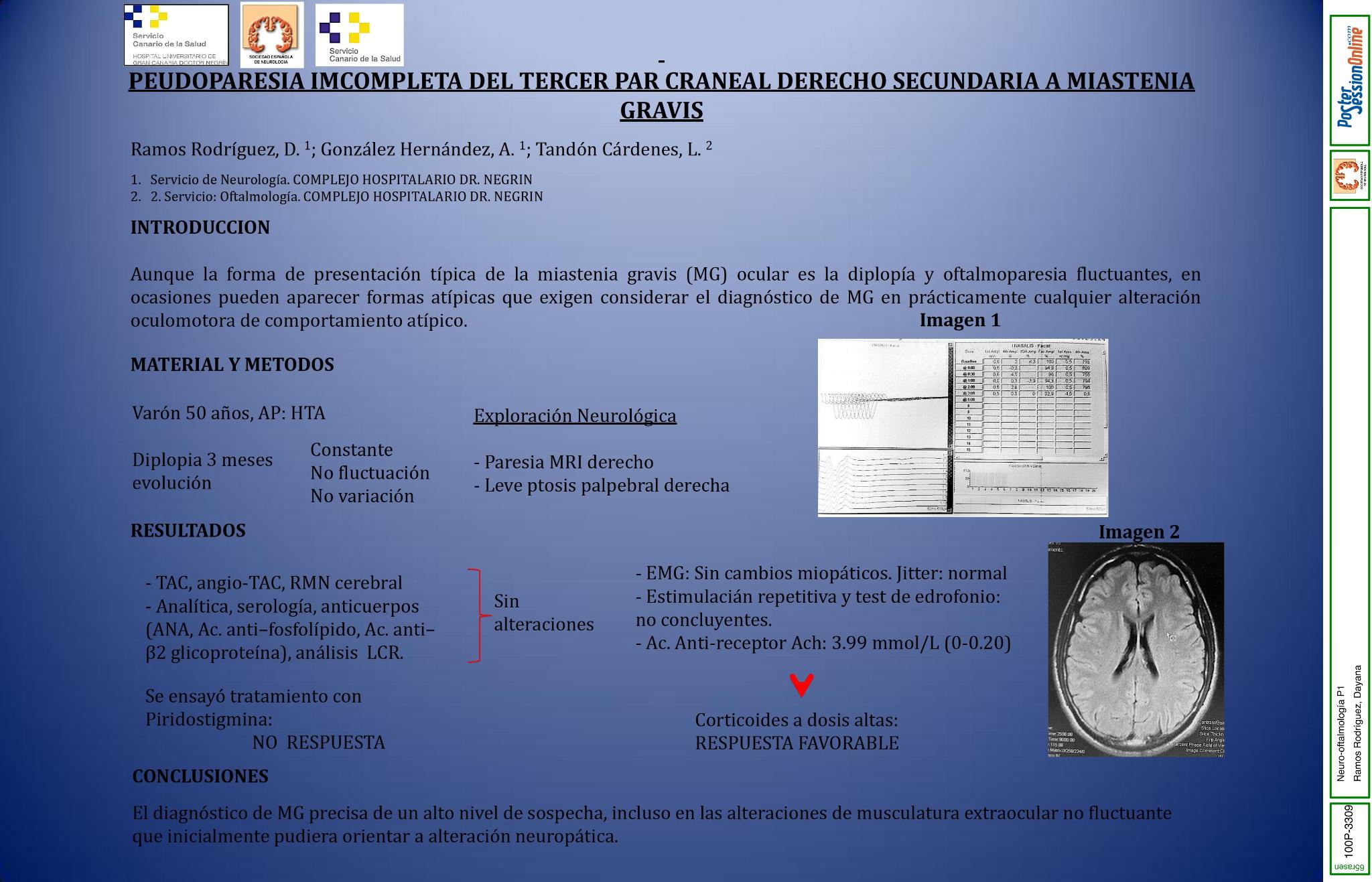 Pseudoparesia incompleta del tercer nervio craneal derecho secundaria a miastenia gravis