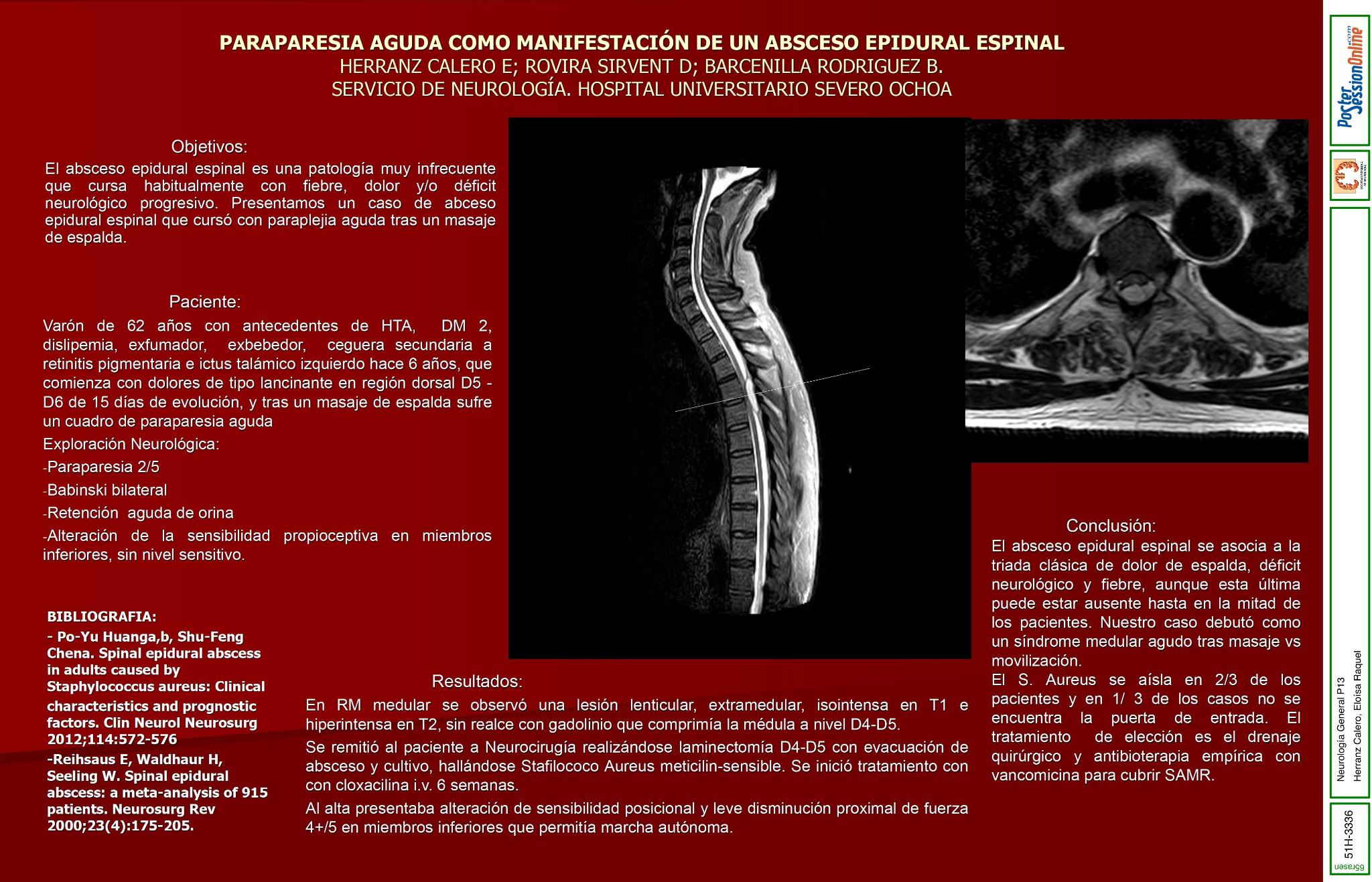 Paraparesia aguda como manifestación de un abceso epidural espinal