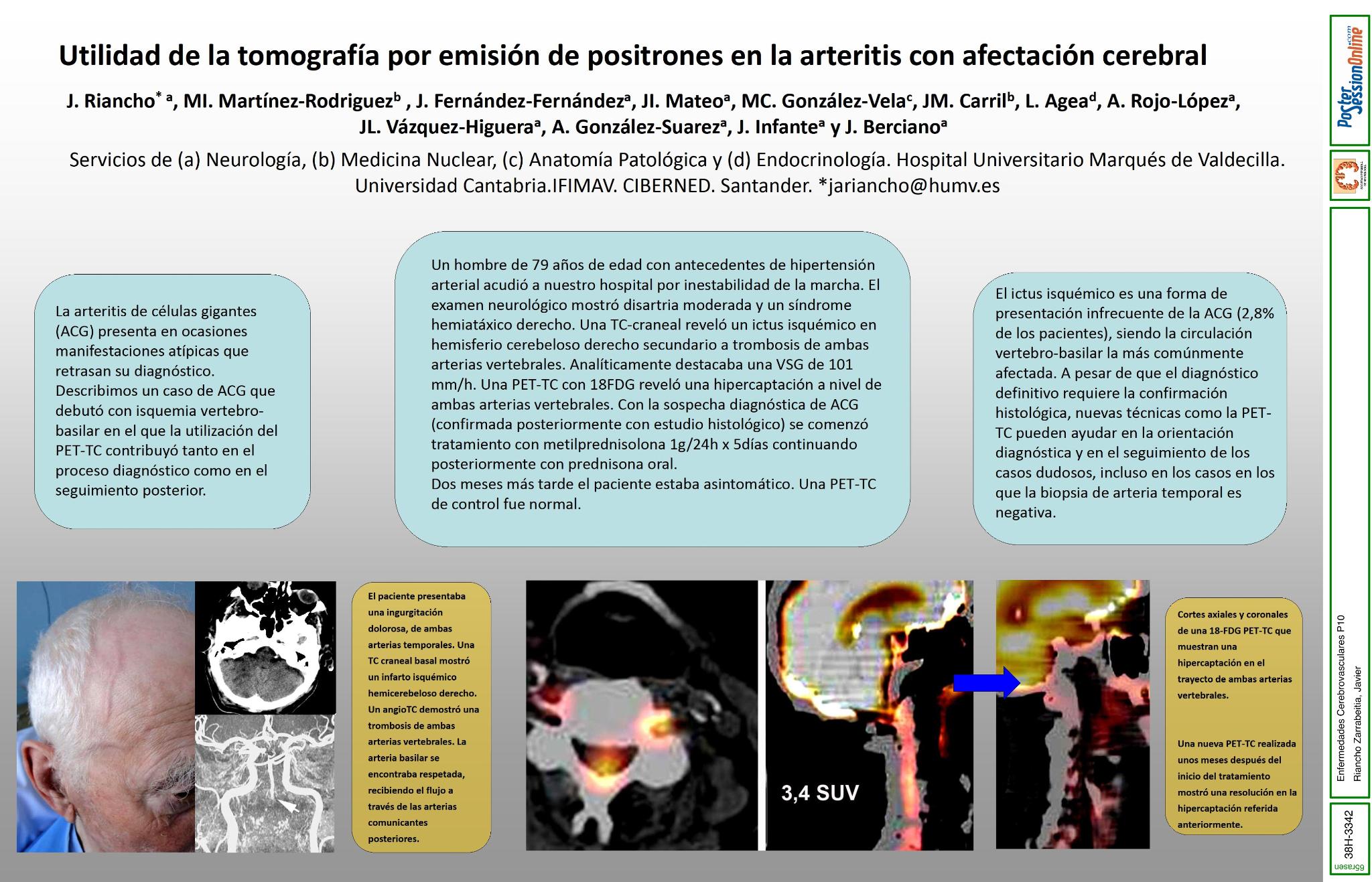 Utilidad de la tomografía por emisión de positrones en la arteritis con afectación cerebral