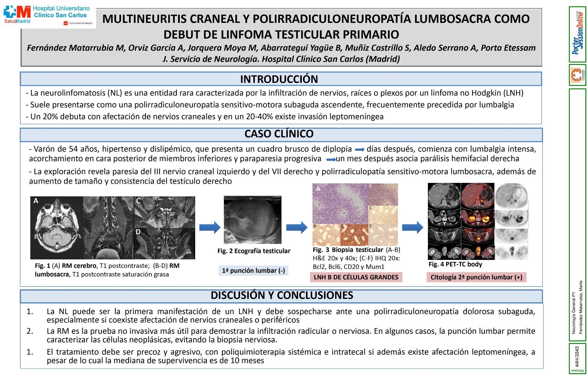 Multineuritis craneal y polirradiculoneuropatía lumbosacra como debut de linfoma testicular primario