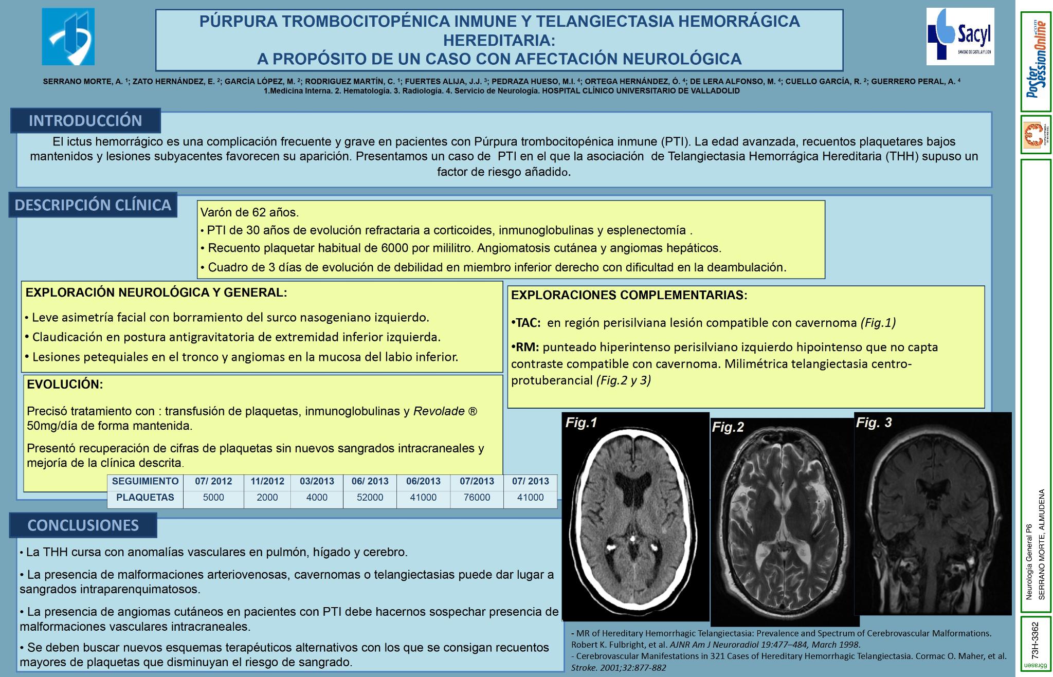 Púrpura Trombocitopénica Inmune y Telangiectasia Hemorrágica Hereditaria: a propósito de un caso con afectación neurológica
