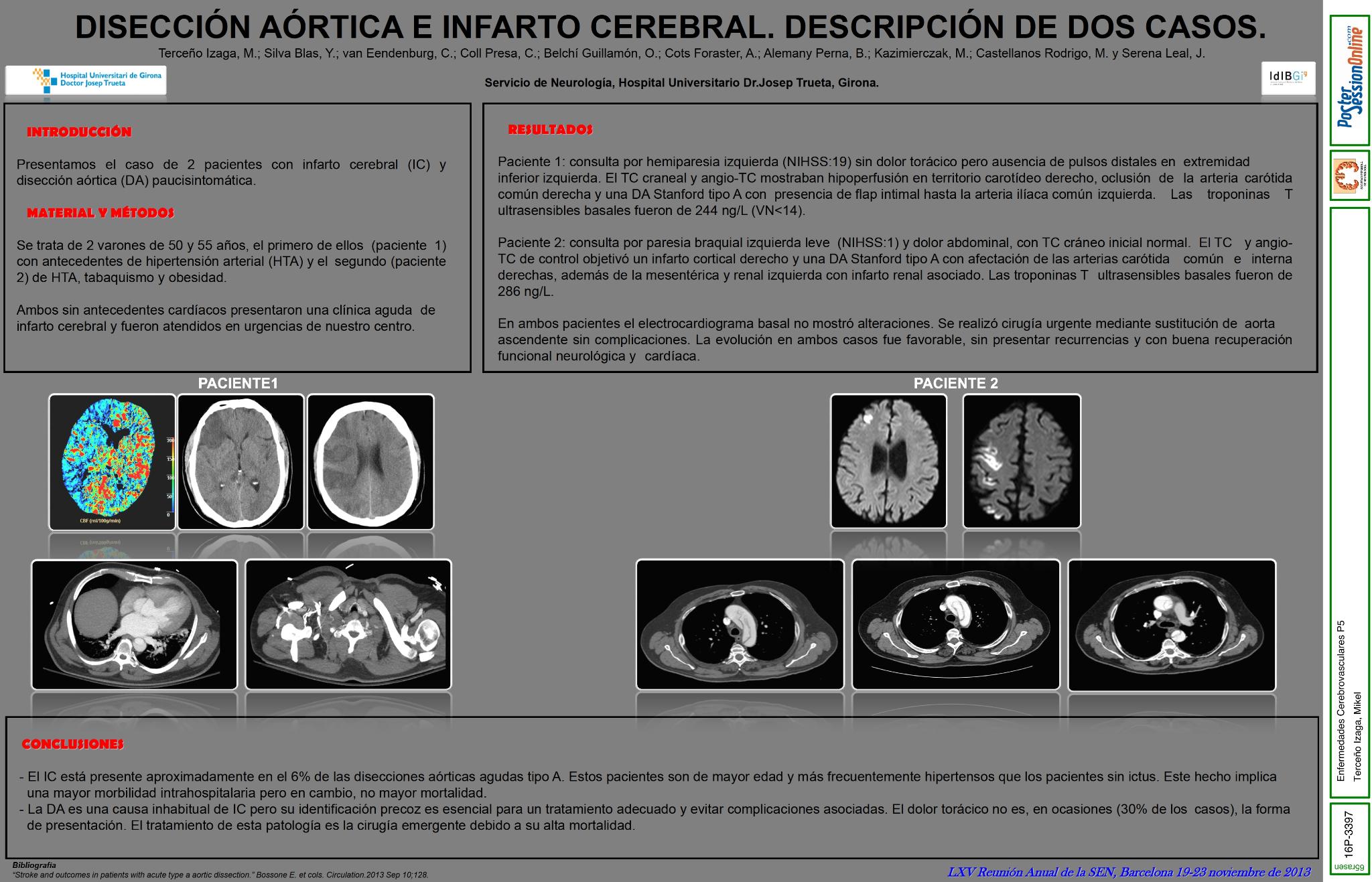 Disección Aórtica e Infarto Cerebral. Descripción de dos casos