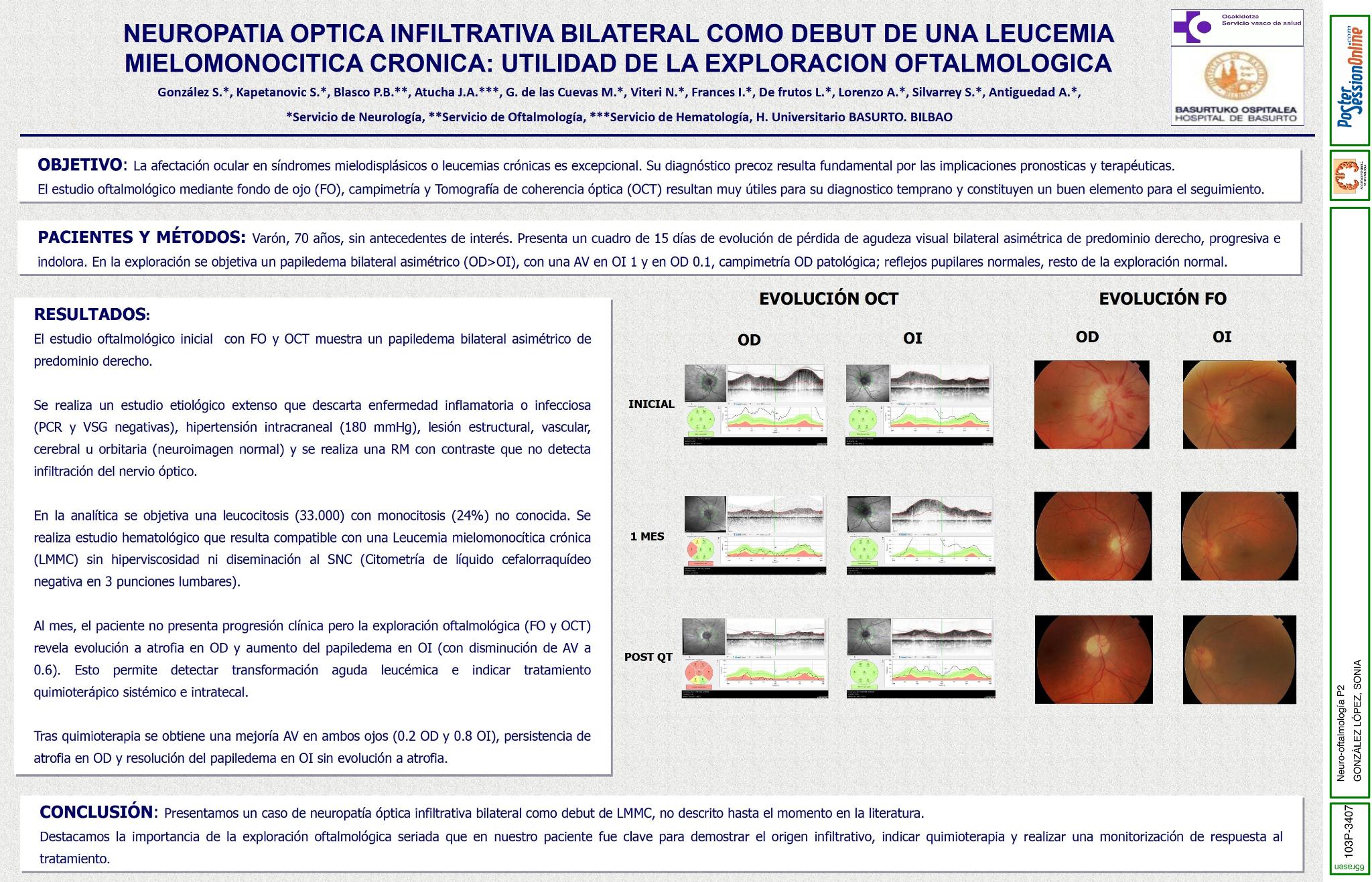 Neuropatia optica infiltrativa bilateral como debut de una Leucemia Mielomonocitica Cronica