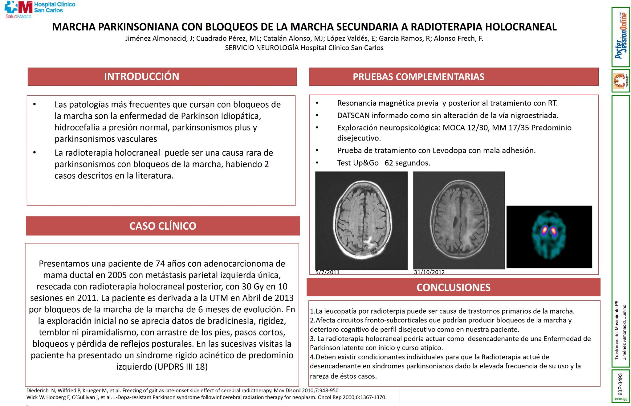 Marcha parkinsonia con bloqueos de la marcha (BDM) secundarios a radioterapia holocraneal