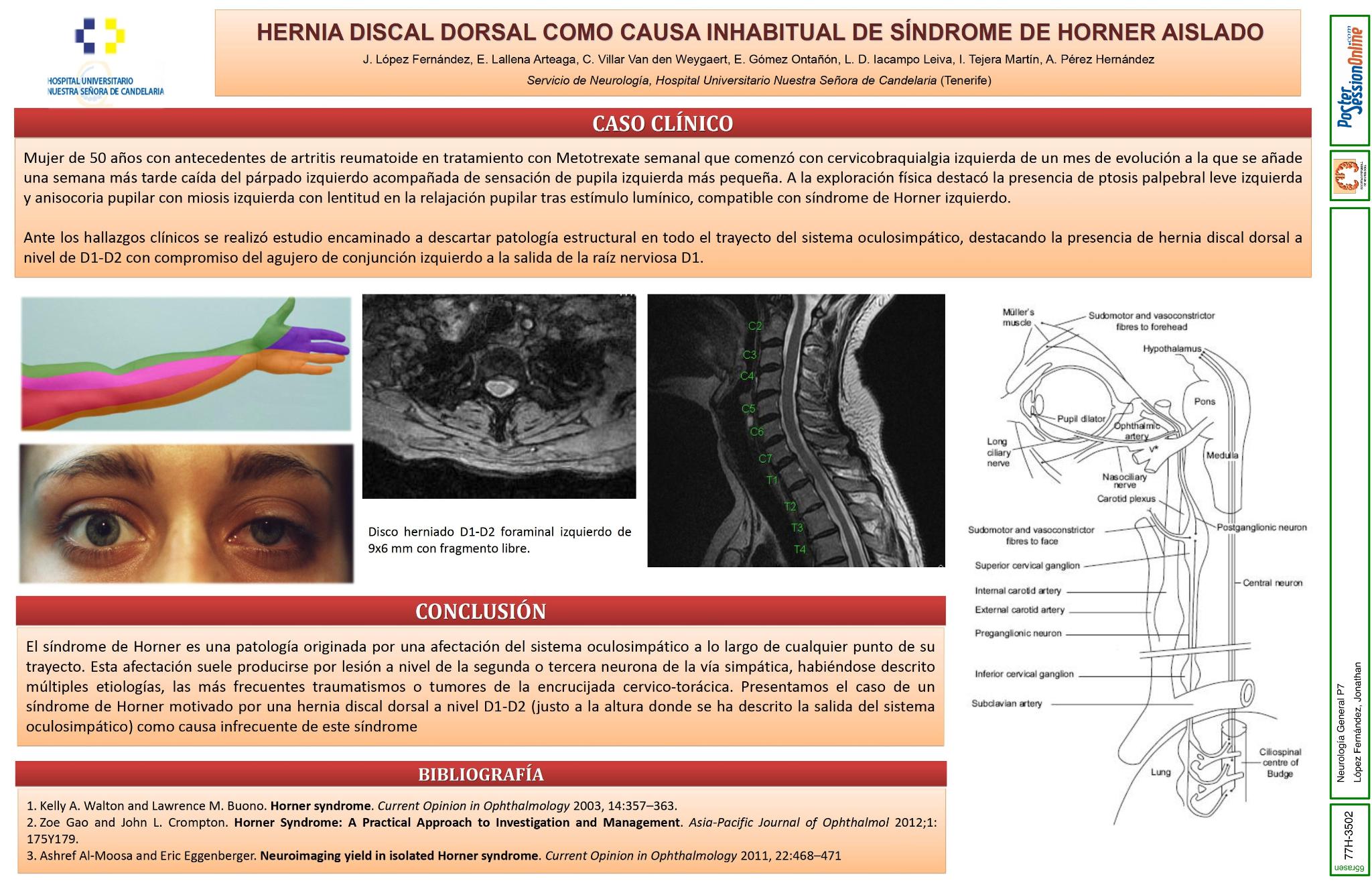 Hernia discal dorsal como causa inhabitual de síndrome de Horner
