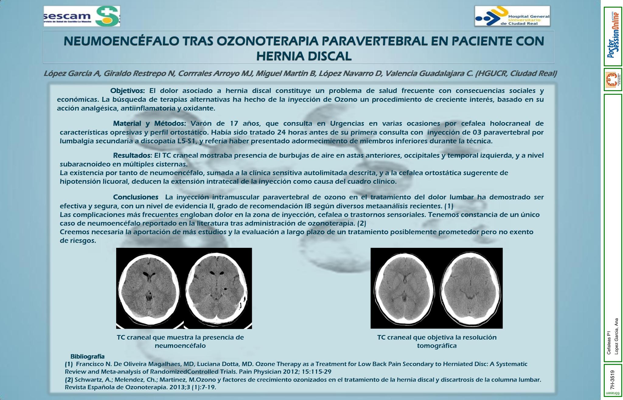 Neumoencéfalo tras ozonoterapia paravertebral en paciente con hernia discal