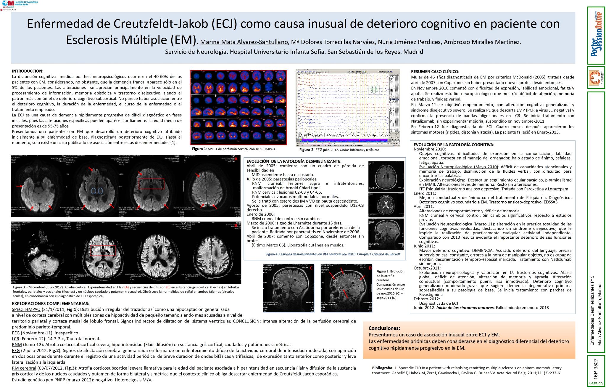 Enfermedad de Creutzfeldt-Jakob (ECJ) como causa inusual de deterioro cognitivo en paciente con Esclerosis Múltiple (EM)
