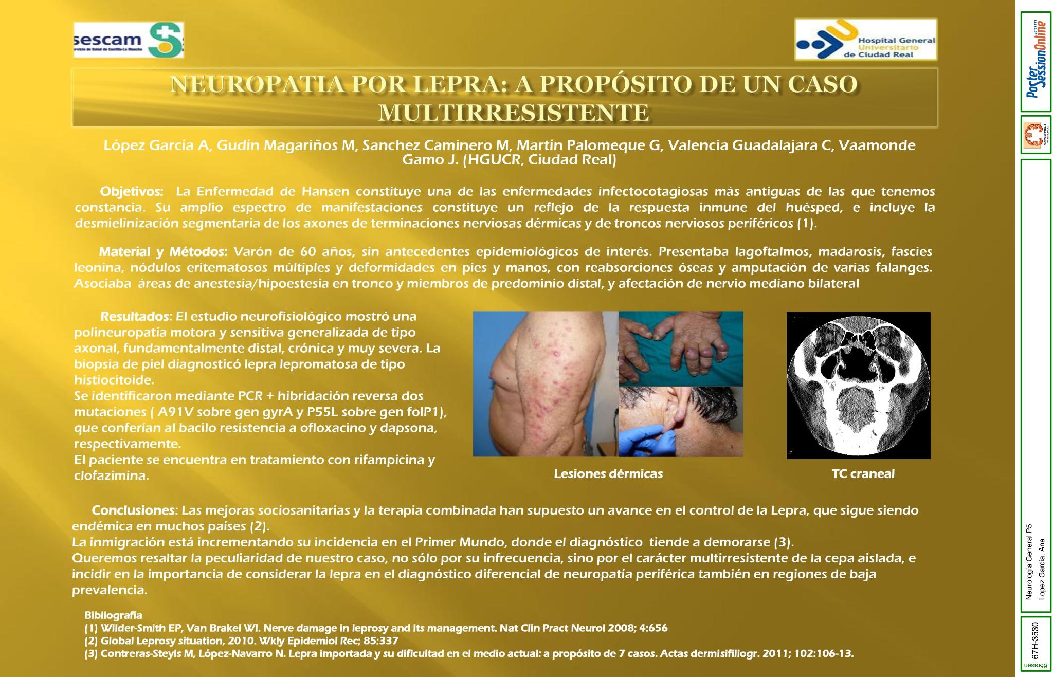 Neuropatia por lepra: a propósito de un caso multirresistente