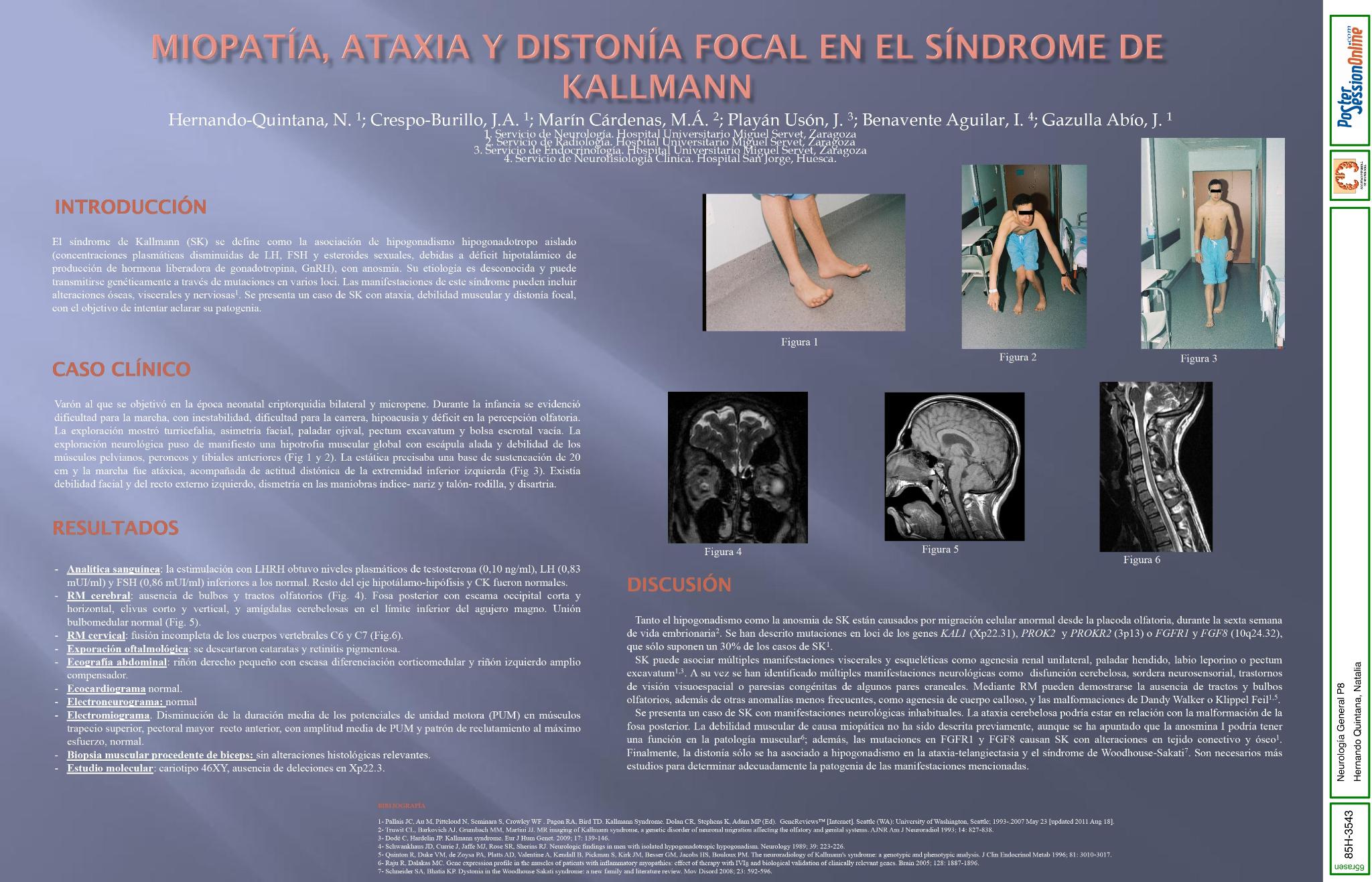 Miopatía, ataxia y distonía focal en el síndrome de Kallmann