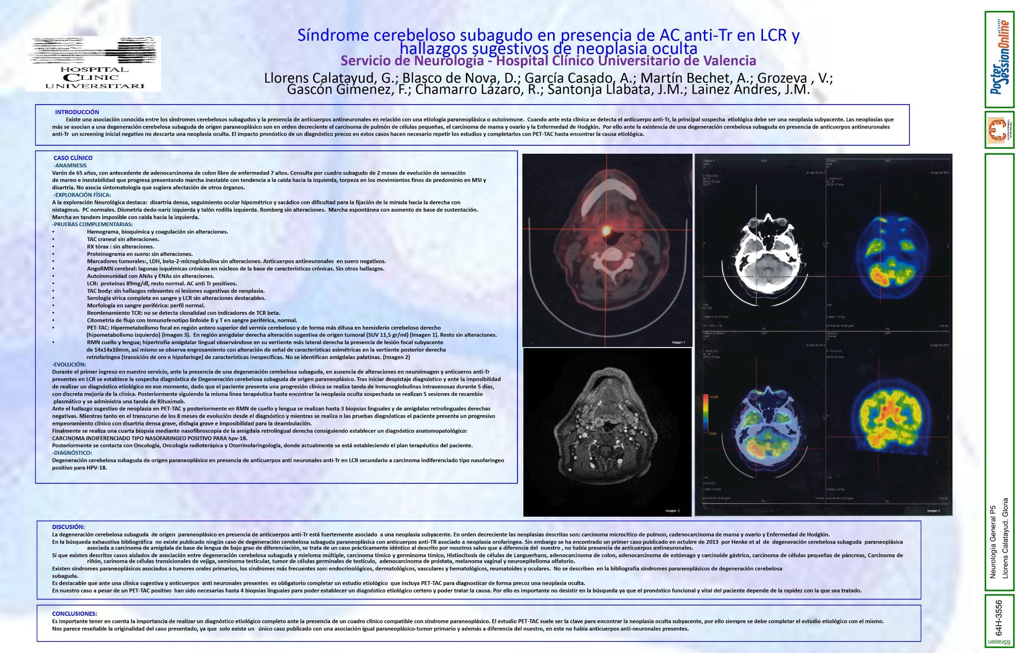 Síndrome cerebeloso subagudo en presencia de anticuerpos anti-Tr