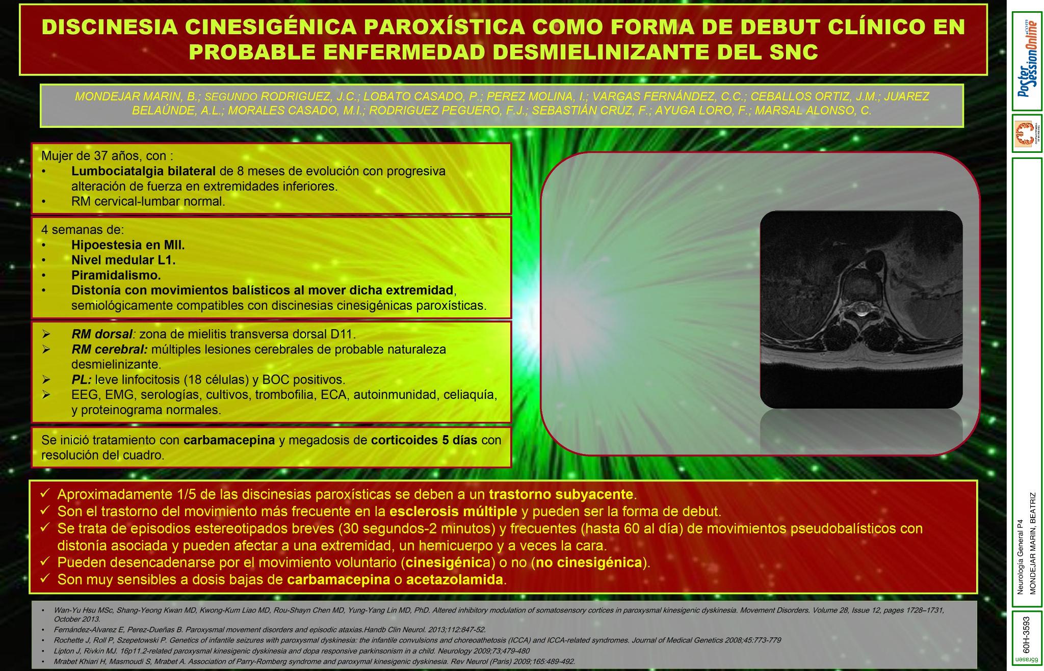 Discinesia cinesigénica paroxística como forma de debut clínico en probable enfermedad desmielinizante del SNC