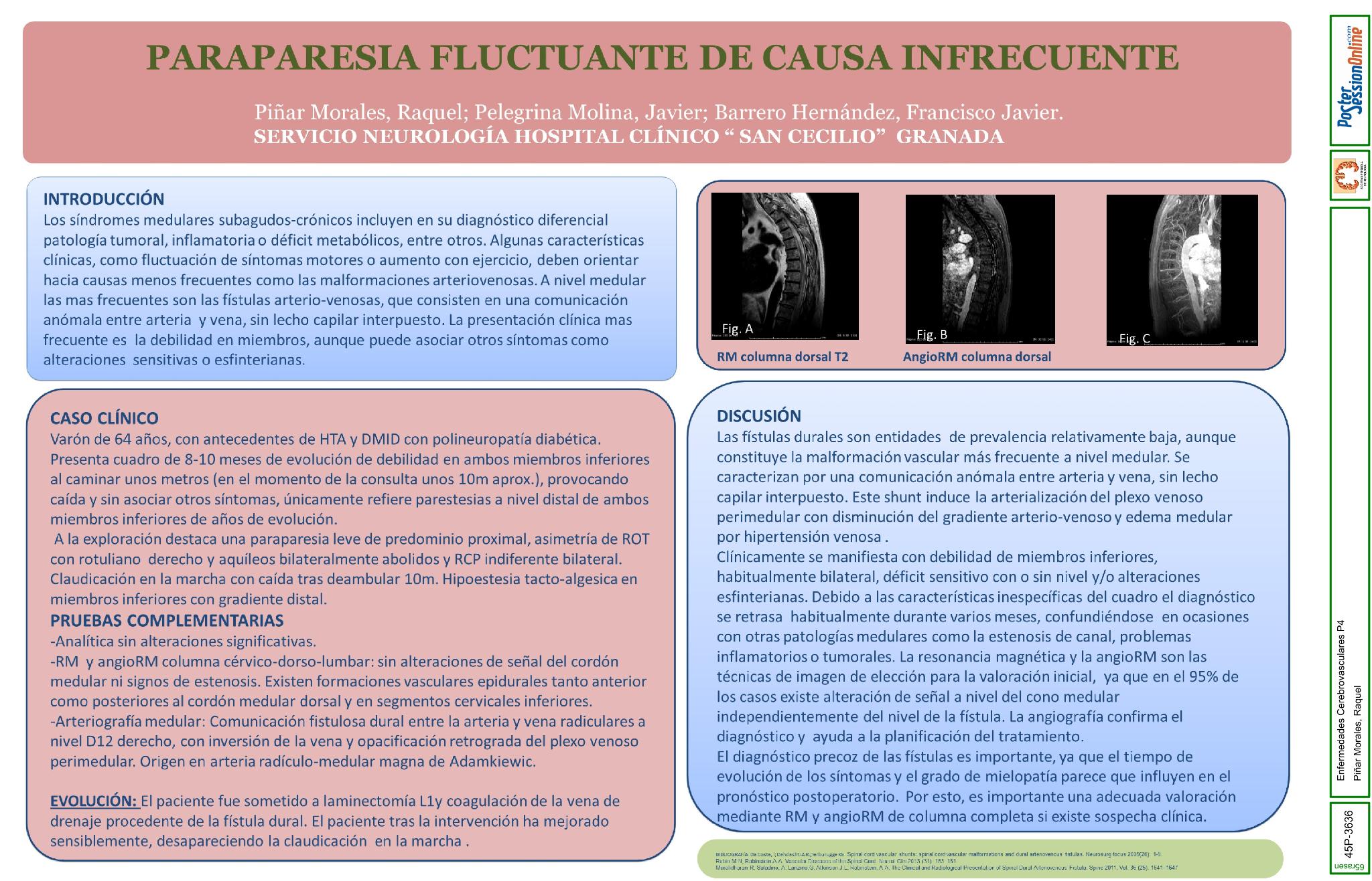 Paraparesia fluctuante de causa infrecuente