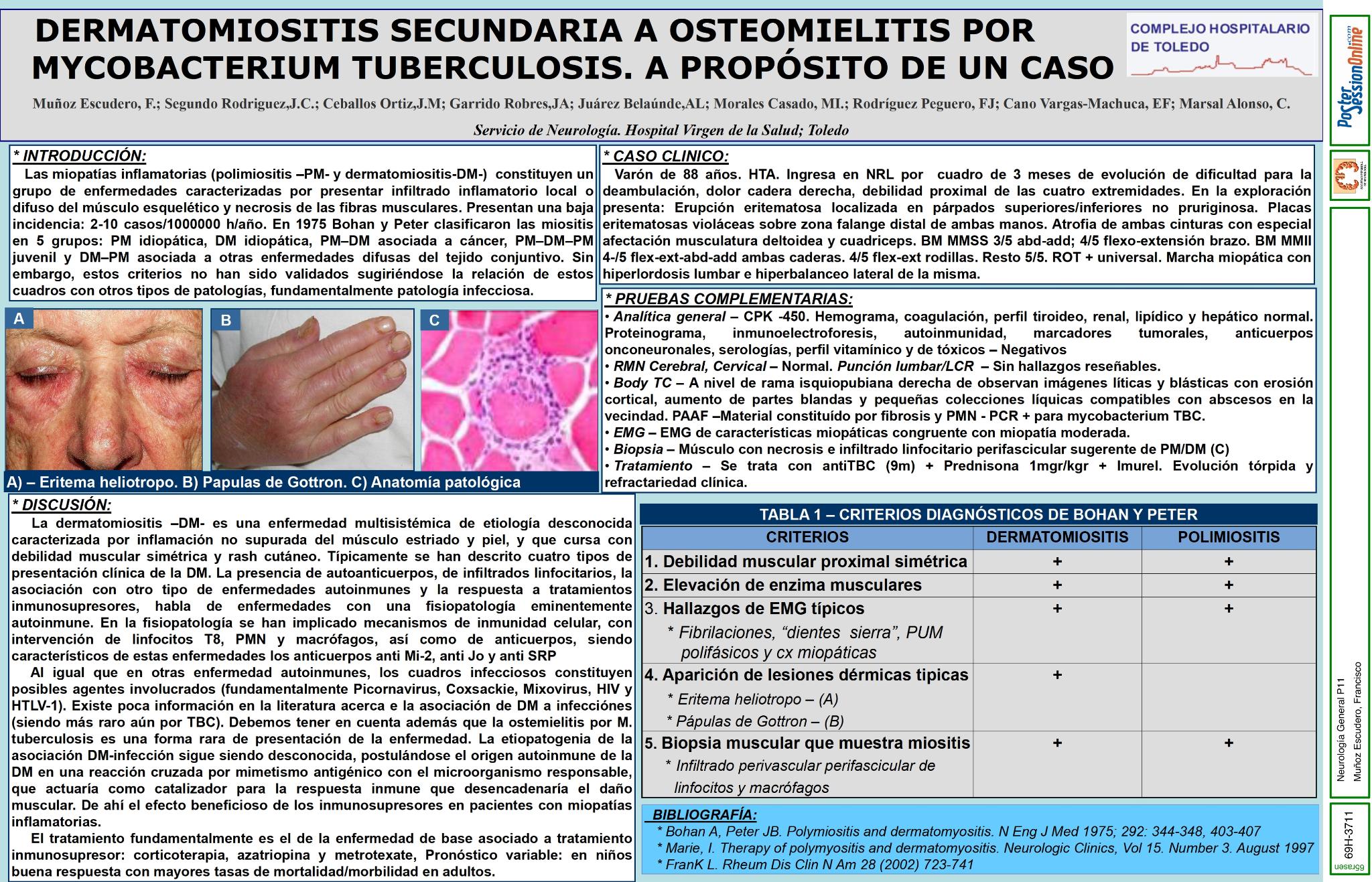 Dermatomiosis secundaria a osteomielitis por mycobacterium tuberculosis. A propósito de un caso