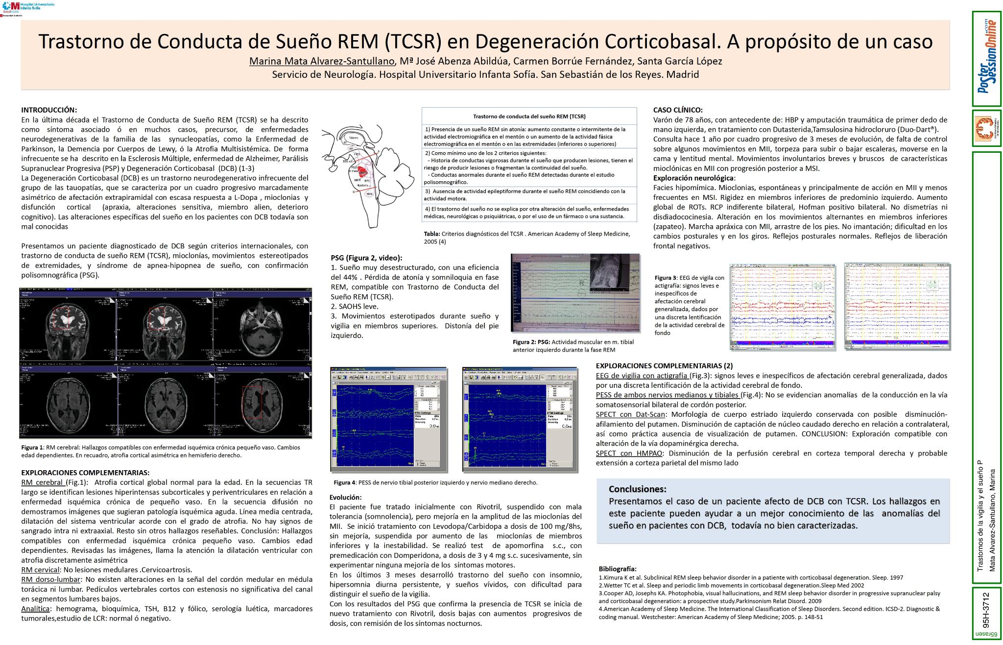 Trastorno de conducta de sueño REM en degeneración corticobasal. A propósito de un caso