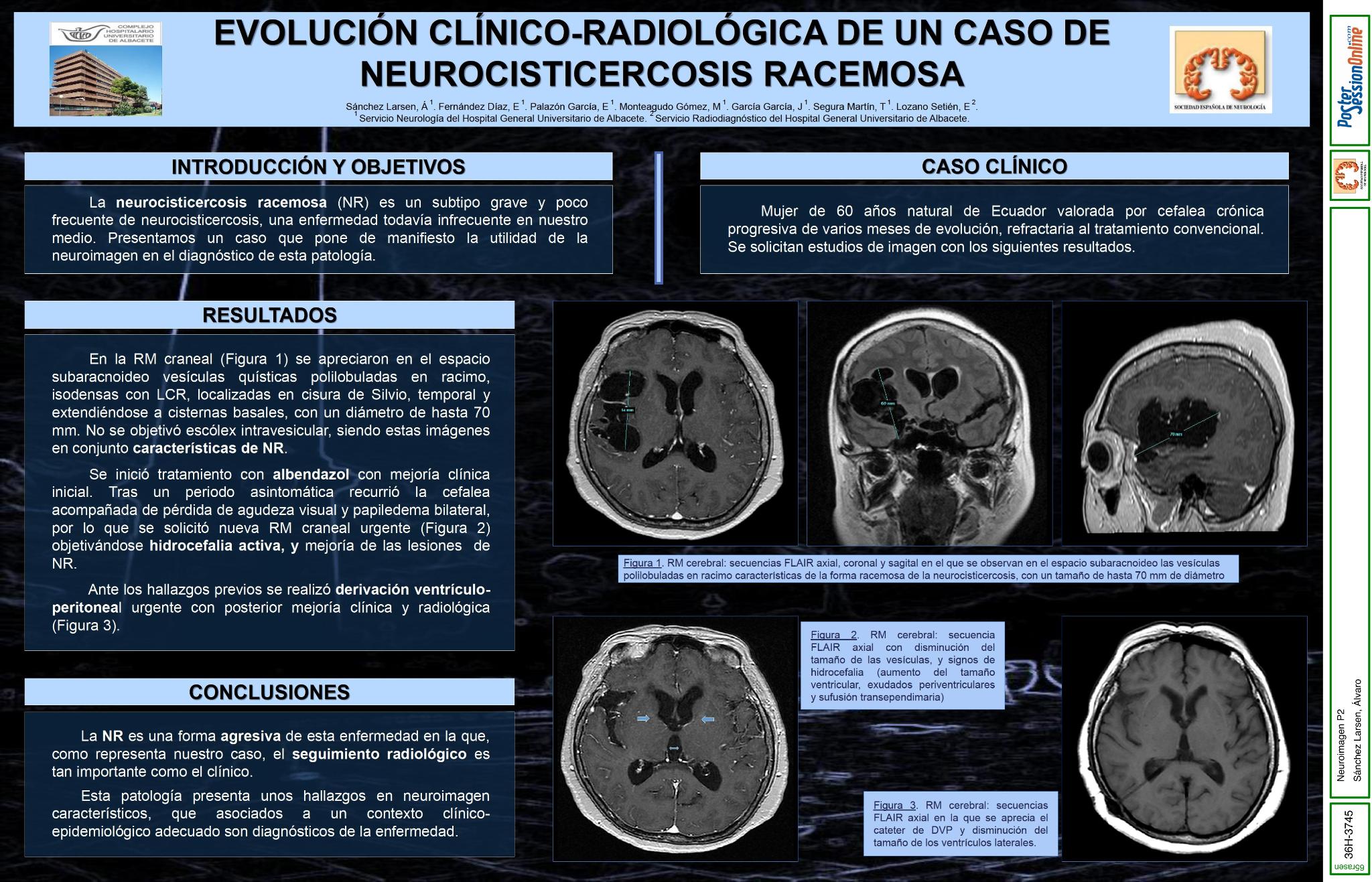 Evolución clínico-radiológica de un caso de neurocisticercosis racemosa.