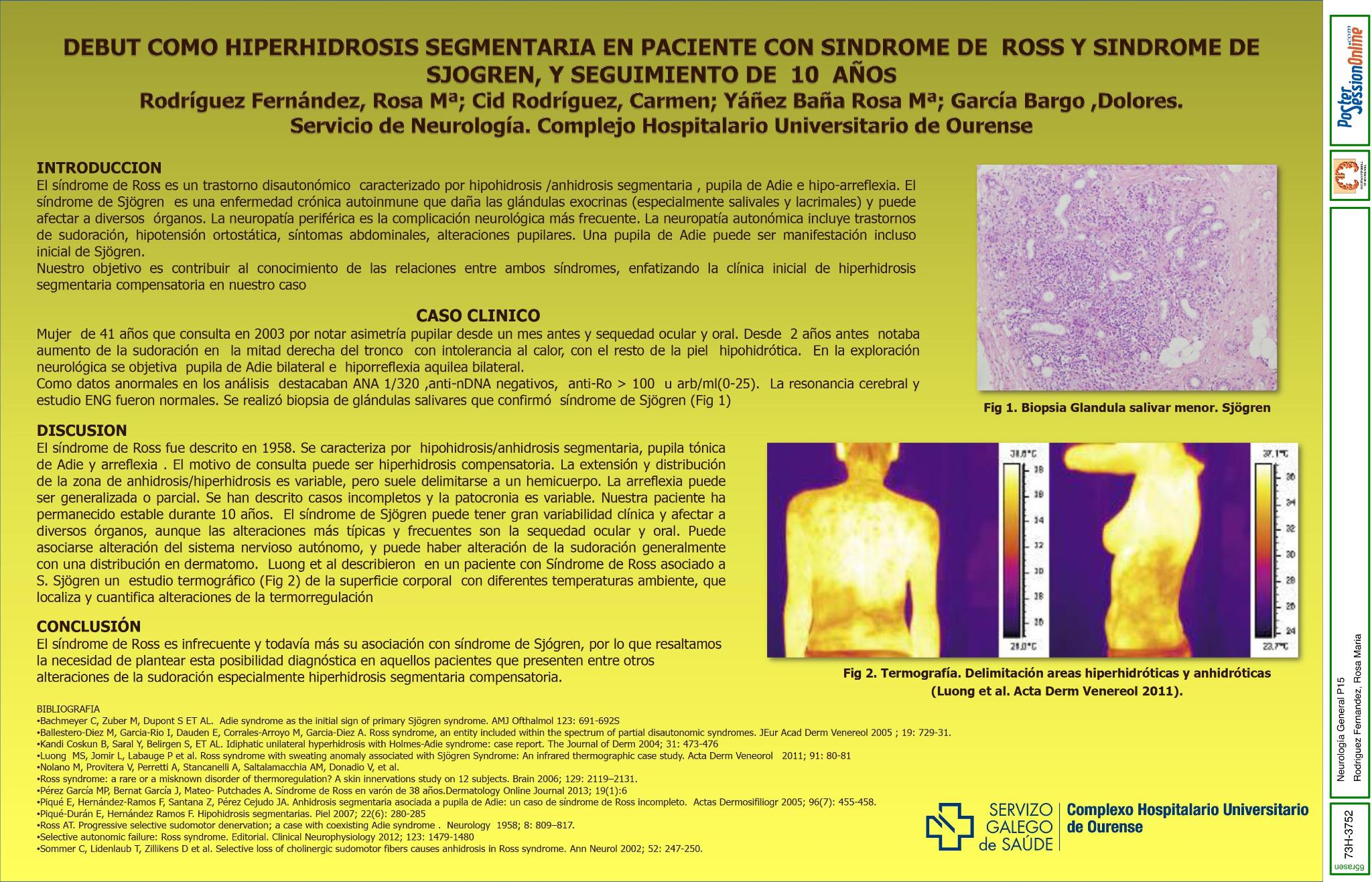 Debut como hiperhidrosis segmentaria en paciente con síndrome de Ross y síndrome de Sjogren, y seguimiento de 10 años