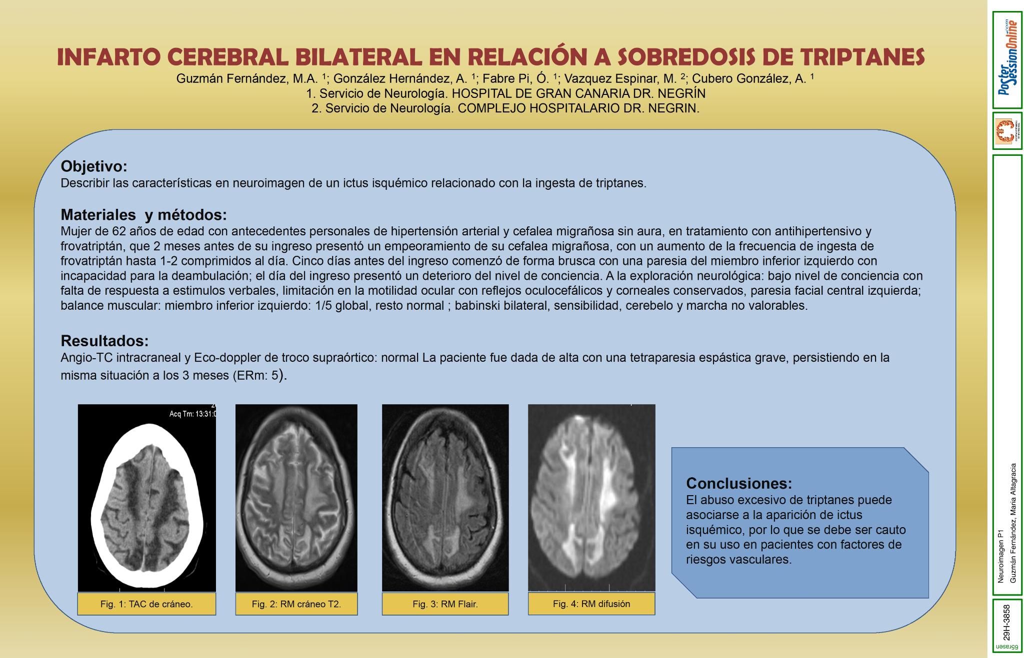 Infarto cerebral bilateral en relación a sobredosis de triptanes