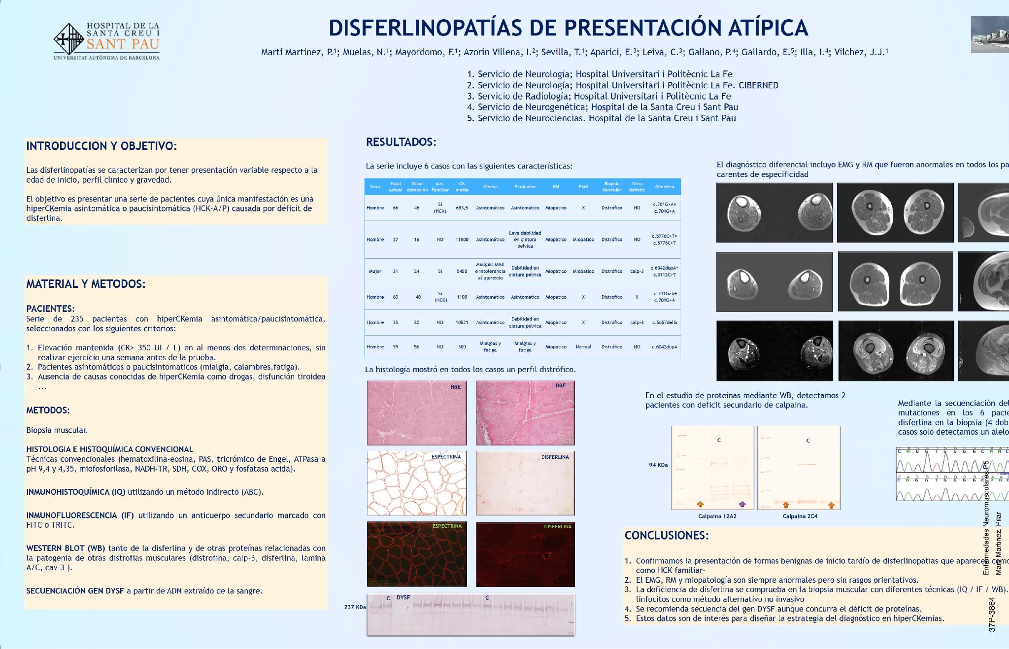 Disferlinopatias de presentación atipica