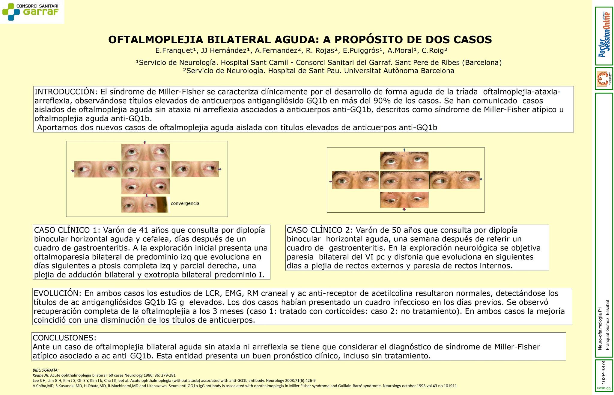 Oftalmoplejia bilateral aguda: a propósito de dos casos