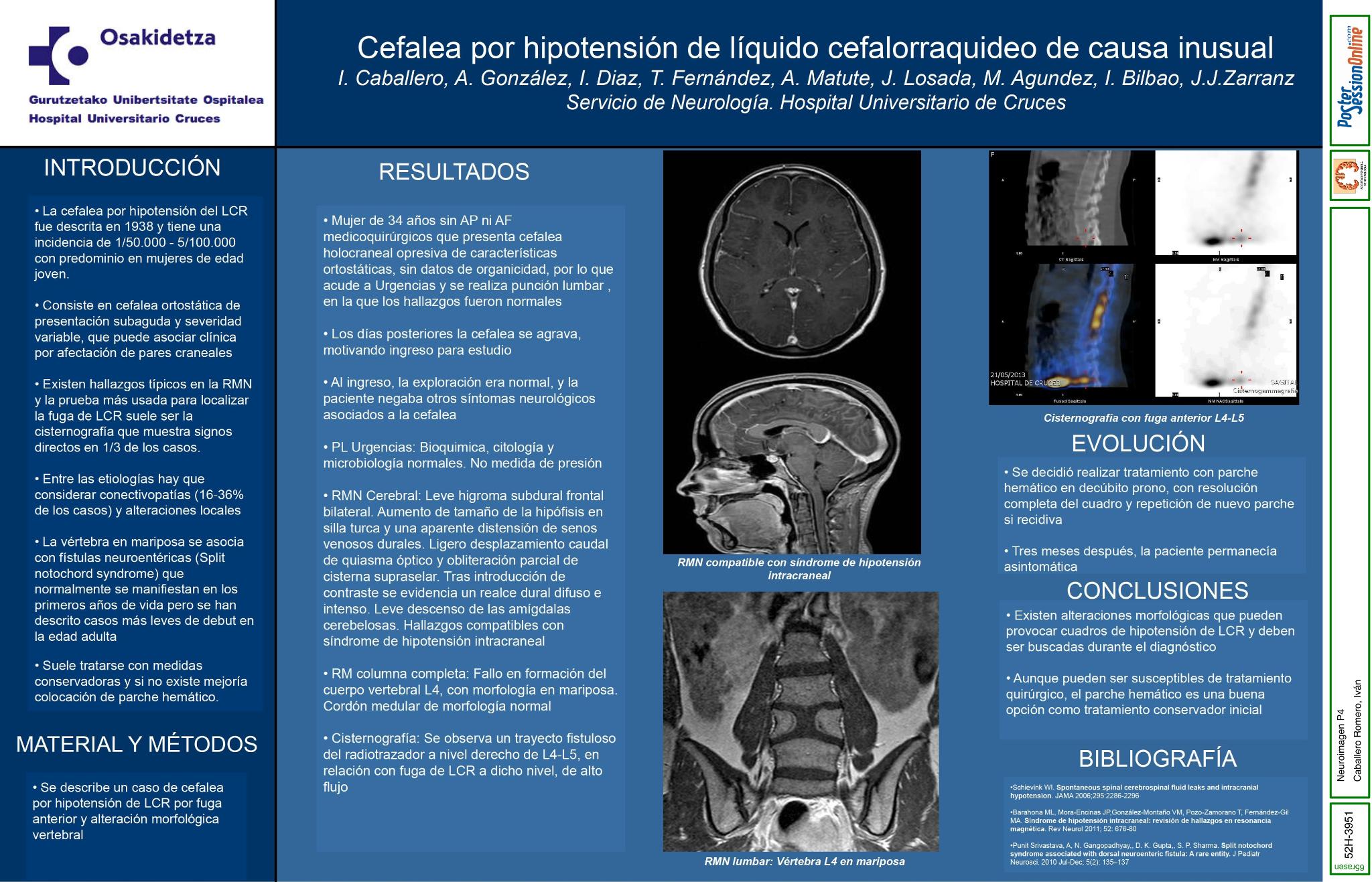 Cefalea por hipotensión del LCR de causa inusual