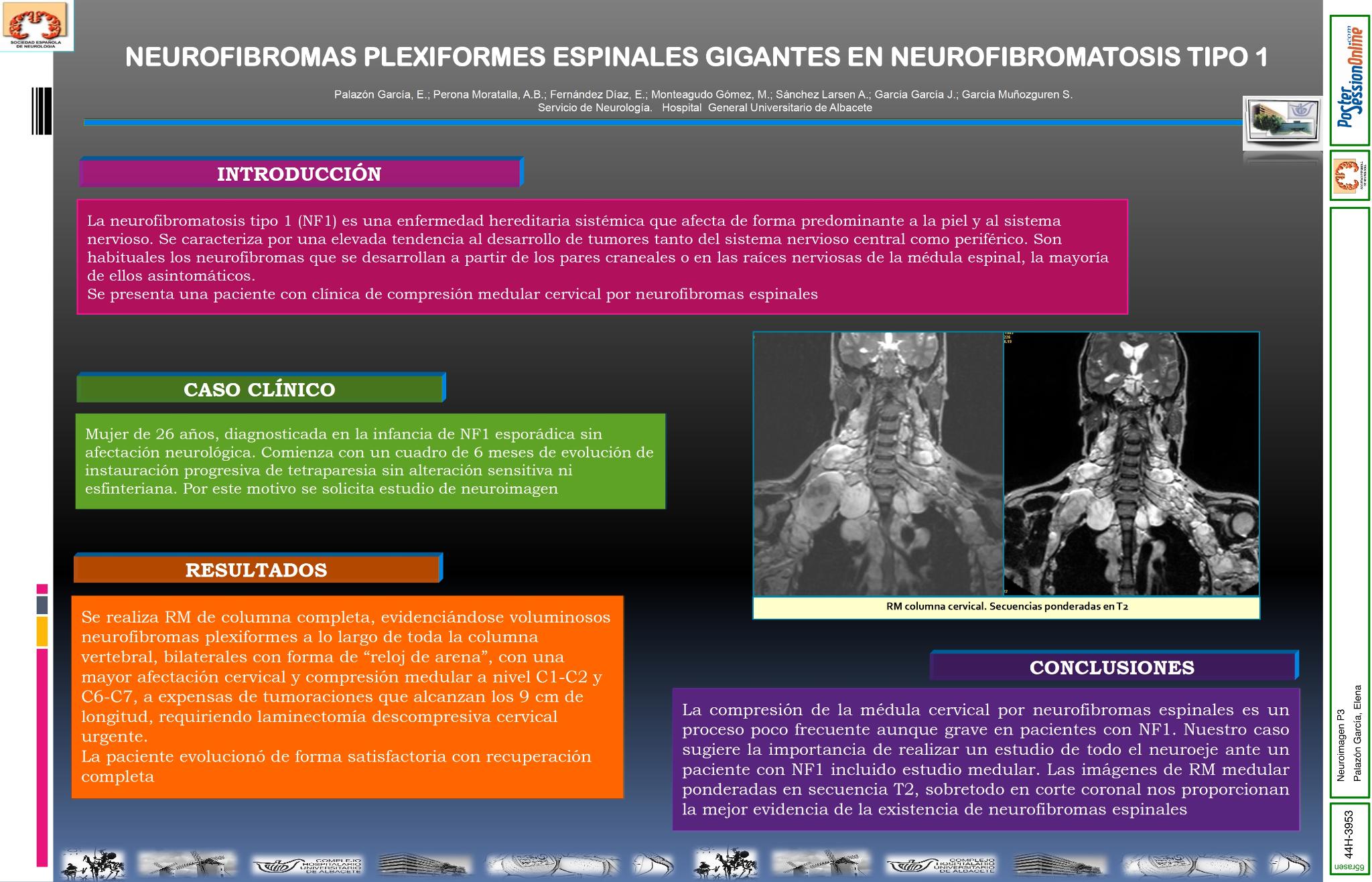 Neurofibromas plexiformes espinales gigantes en neurofibromatosis tipo 1