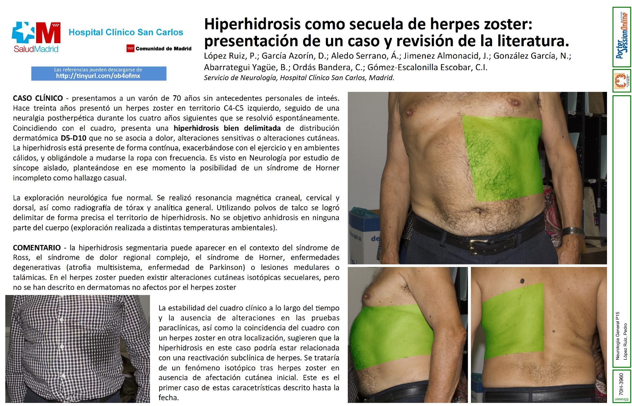 Hipersudoración crónica focal como única secuela de herpes zoster torácico