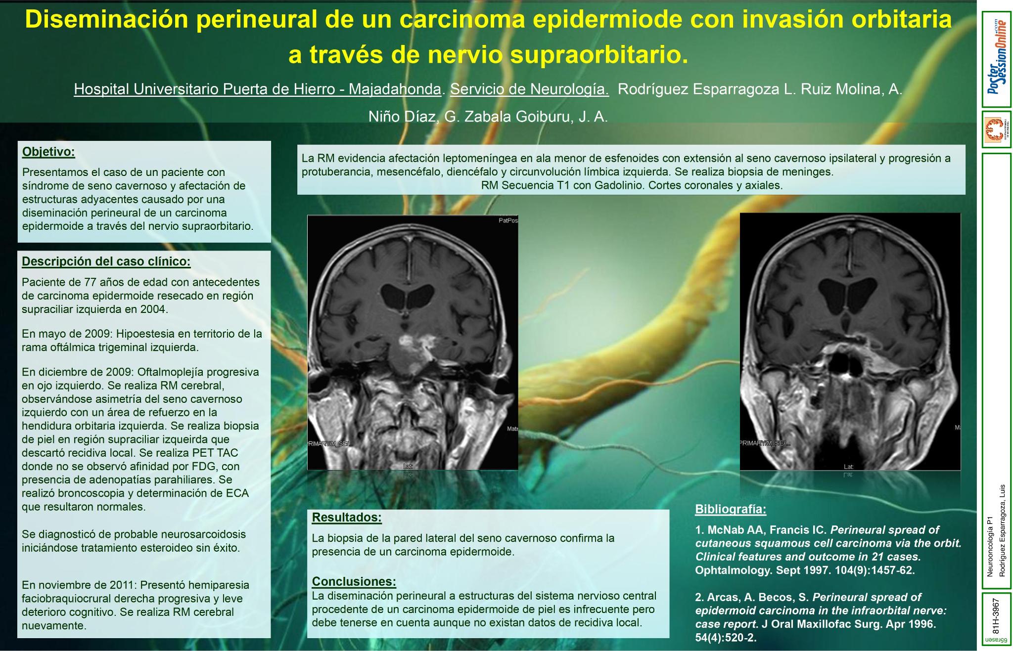 Diseminación perineural de un carcinoma epidermoide con invasión orbitaria a través de nervio supraorbitario