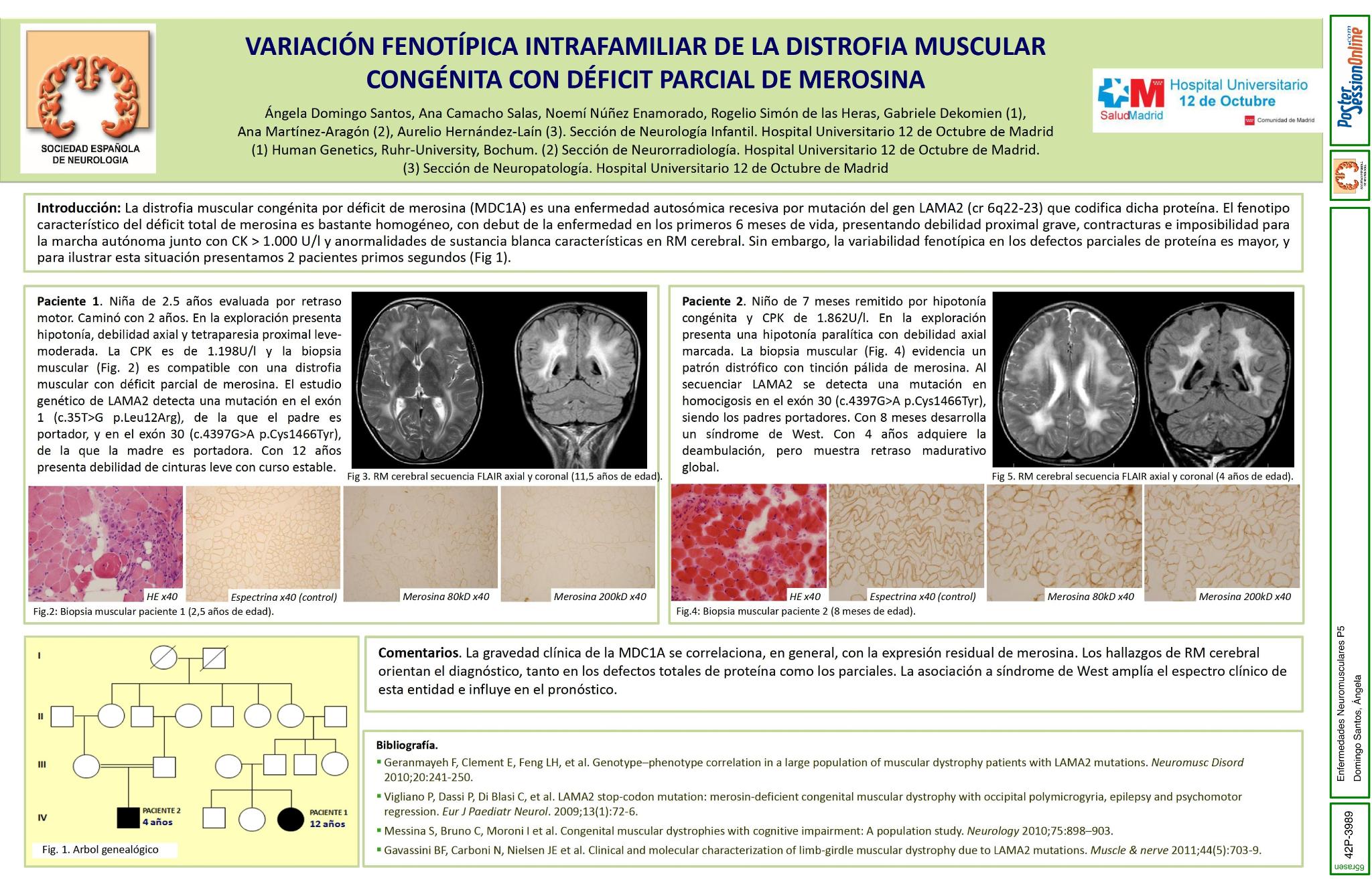Variación fenotípica intrafamiliar de la distrofia muscular congénita con déficit parcial de merosina