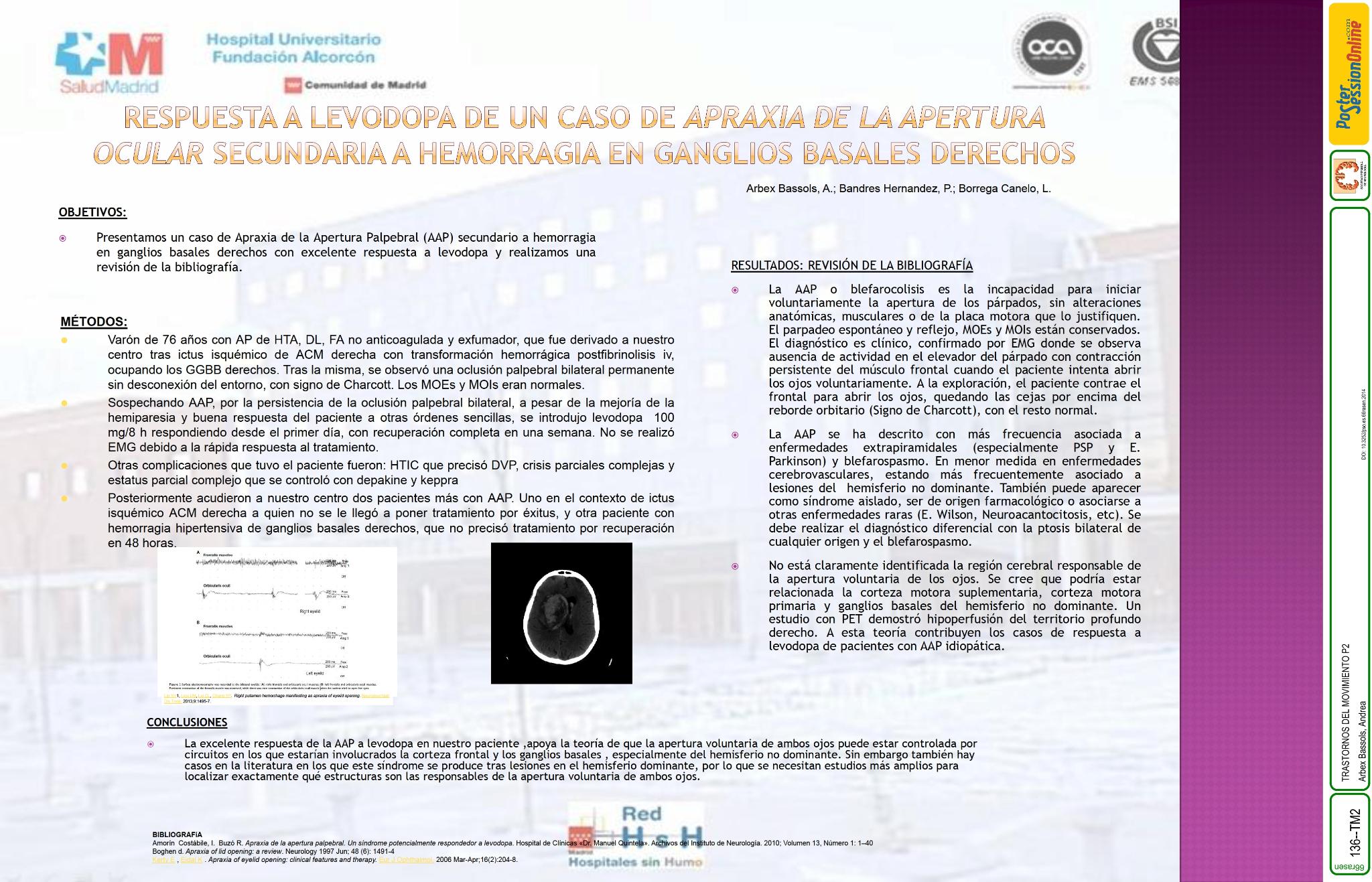 Respuesta a levodopa de un caso de apraxia de la apertura ocular secundaria a hemorragia en ganglios basales derechos