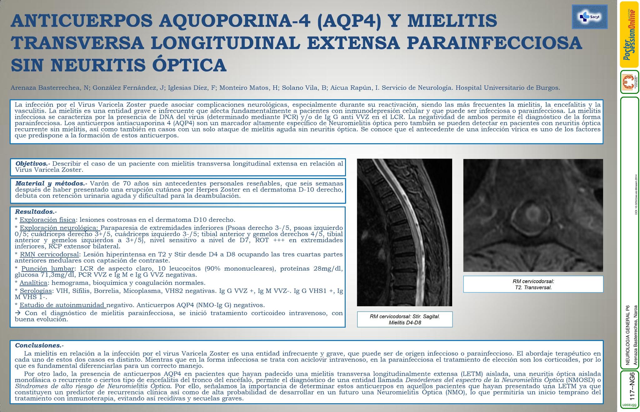 Anticuerpos Aquoporina-4 (AQP4) y mielitis transversa longitudinal extensa parainfecciosa sin neuritis optica