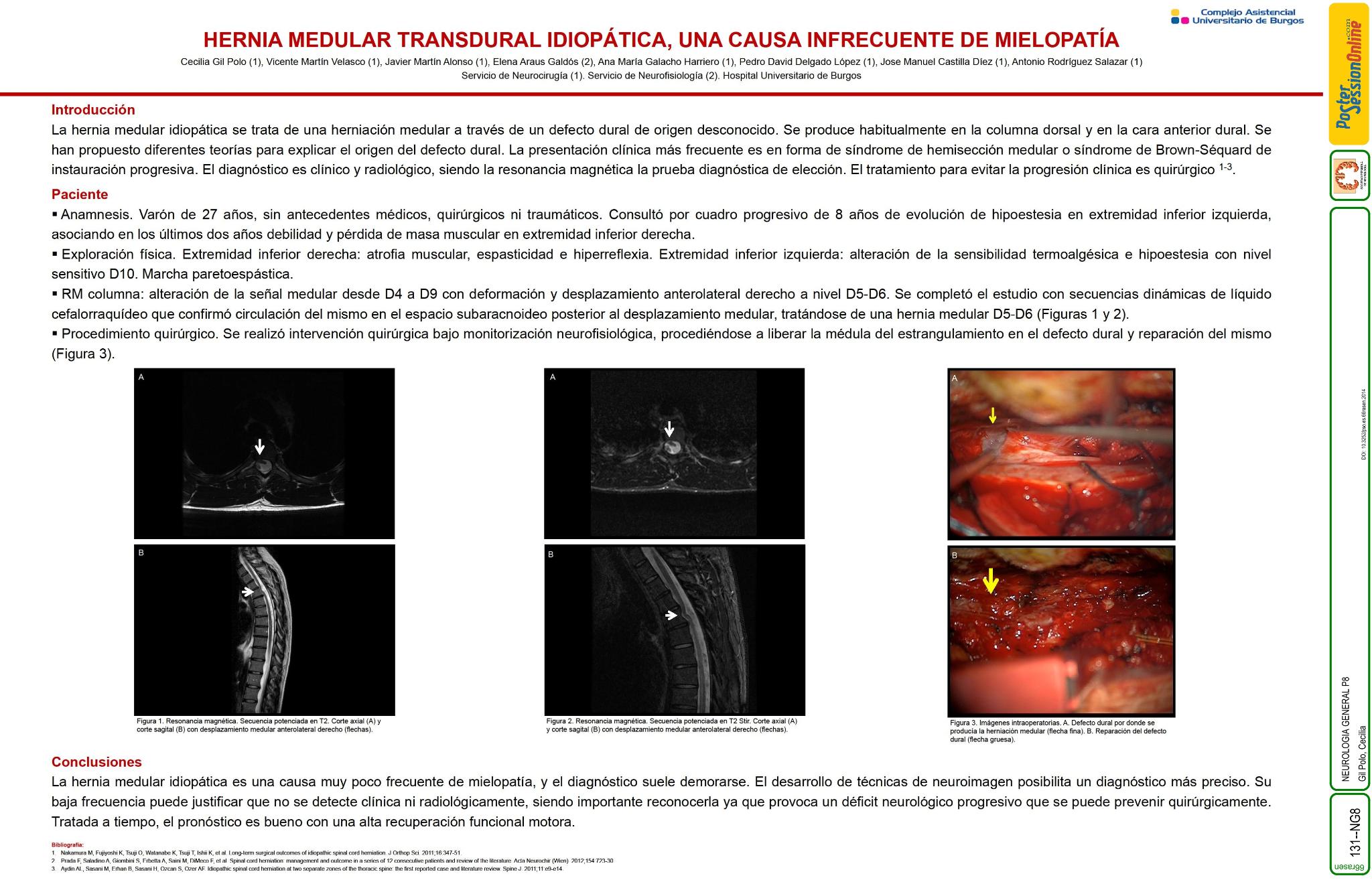 Hernia medular transdural idiopática, una causa infrecuente de mielopatía