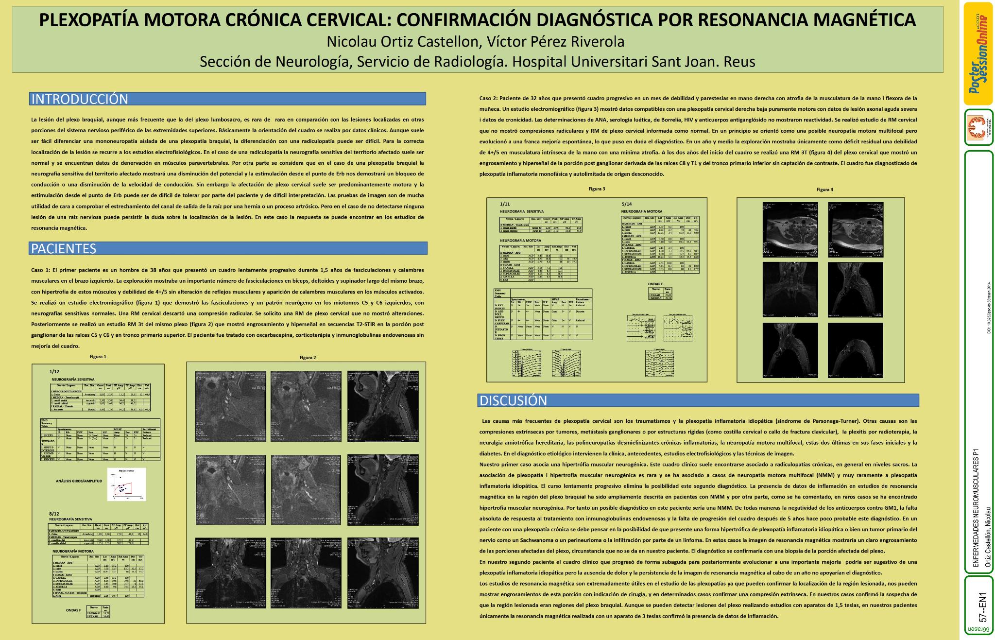 Plexopatía motora crónica cervical: confirmación diagnóstica por Resonancia Magnética