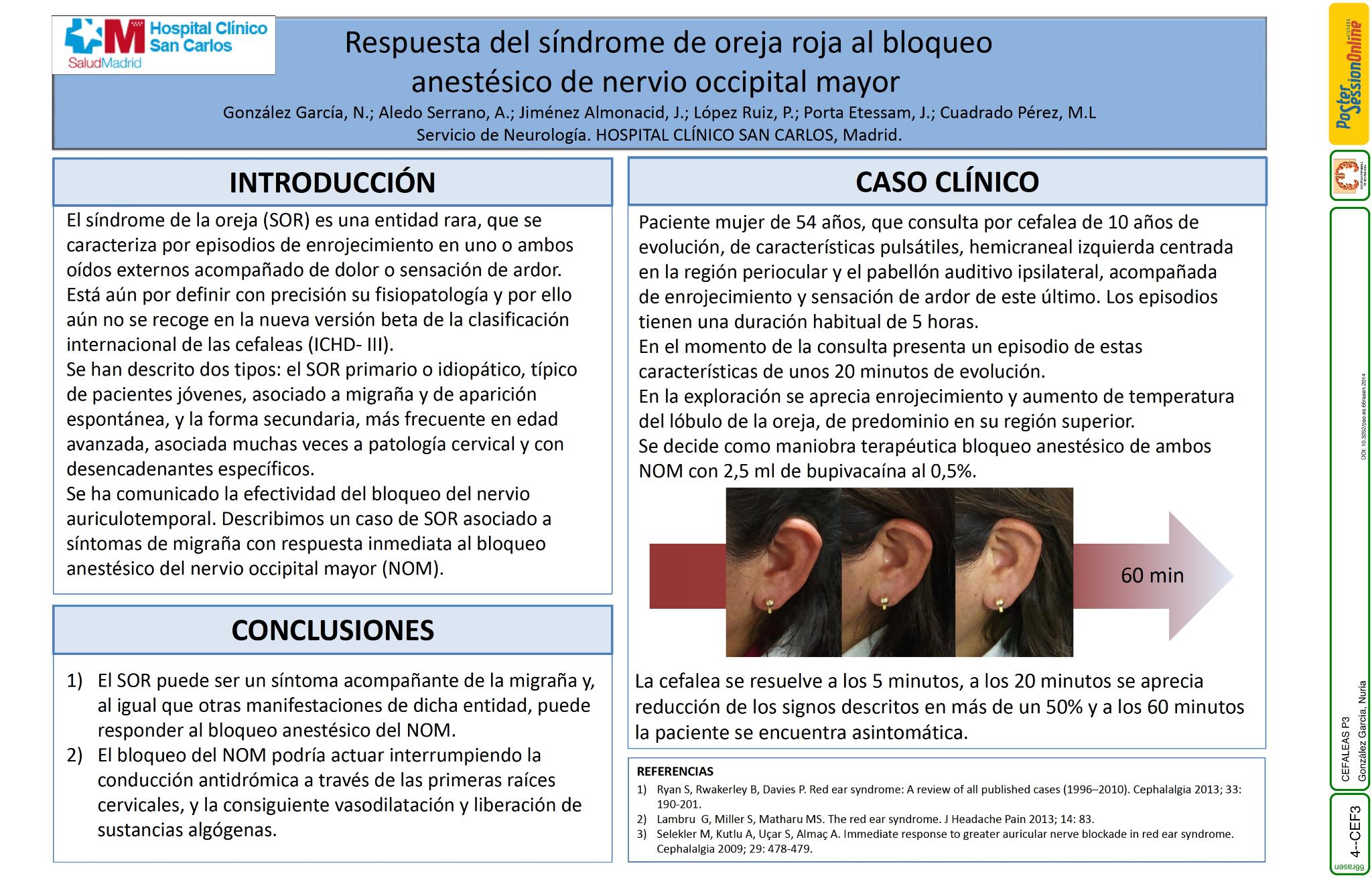 Respuesta del síndrome de oreja roja al bloqueo anestésico de nervio occipital mayor (NOM)