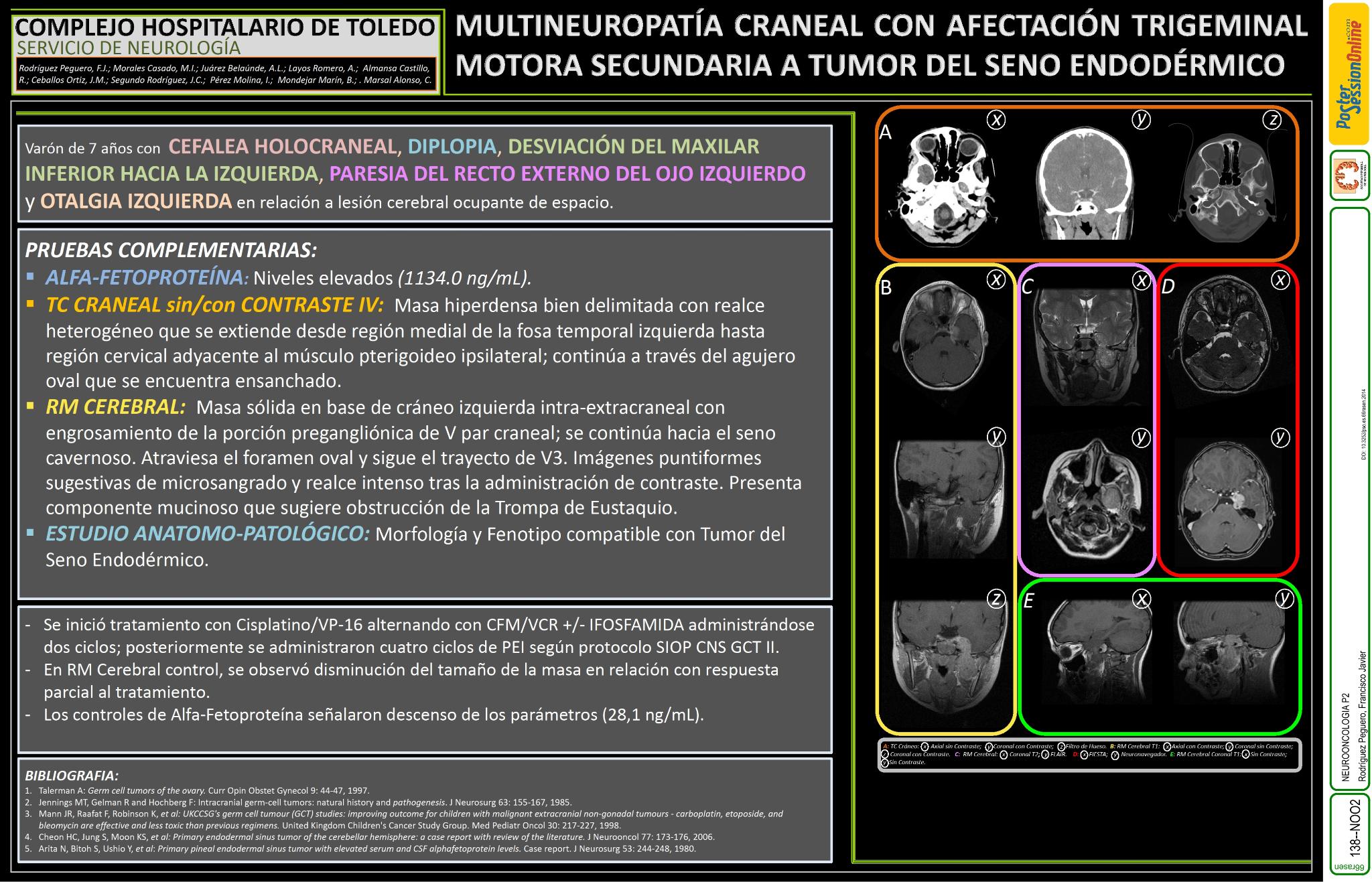 Multineuropatia craneal con afectacion trigeminal motora secundaria a tumor del seno endodermico