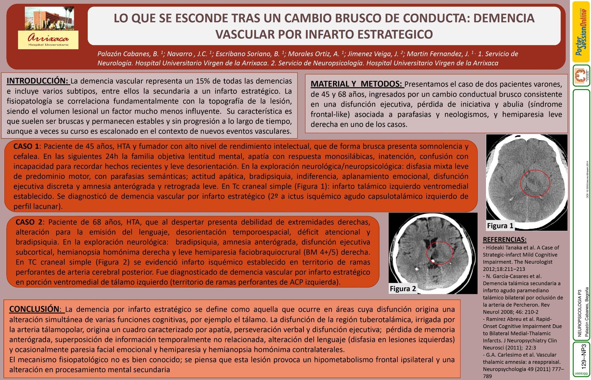 Lo que se esconde tras un cambio brusco de conducta: demencia vascular por infarto estrategico